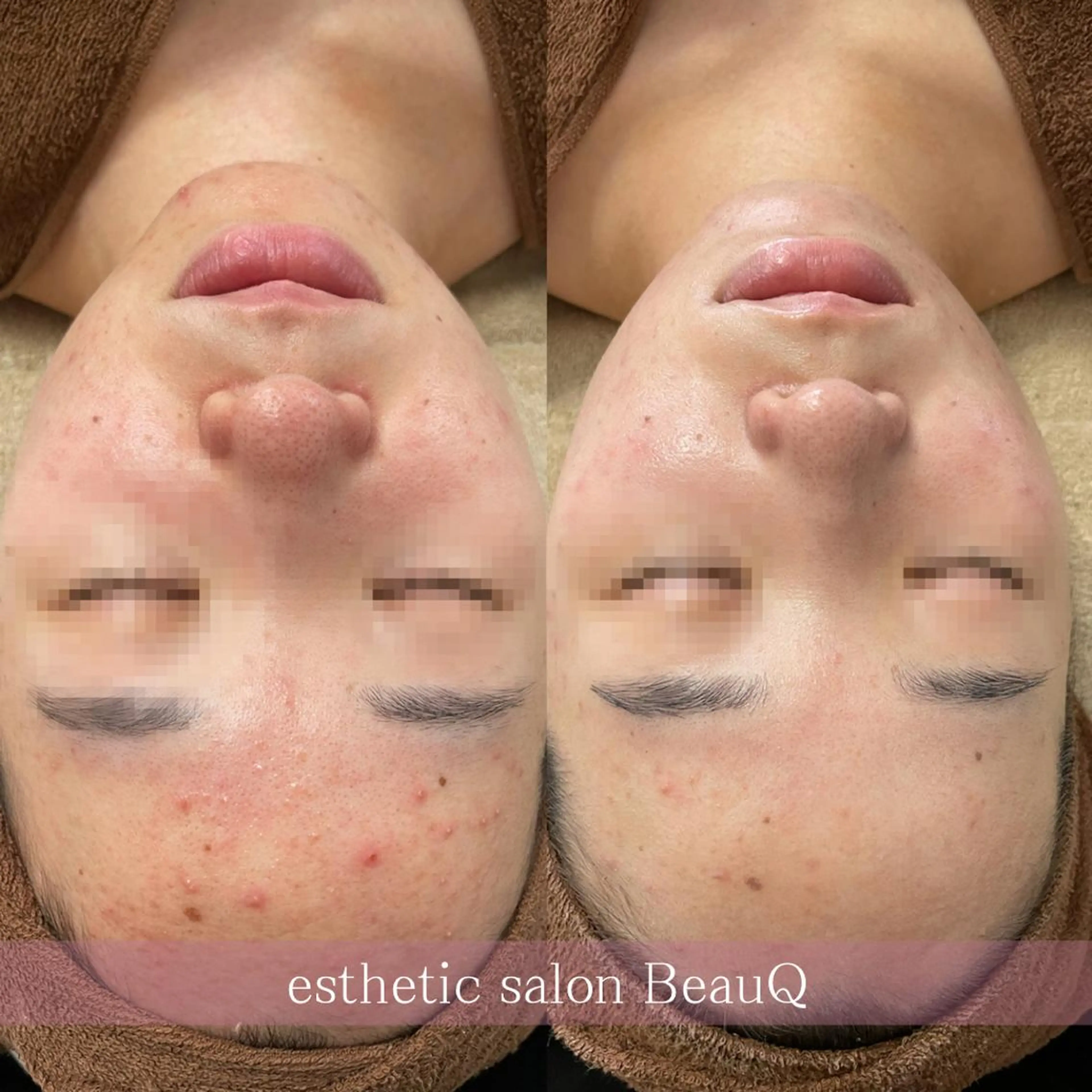 肌質改善/ブライダル 水上百華のエステ・リラクイメージ