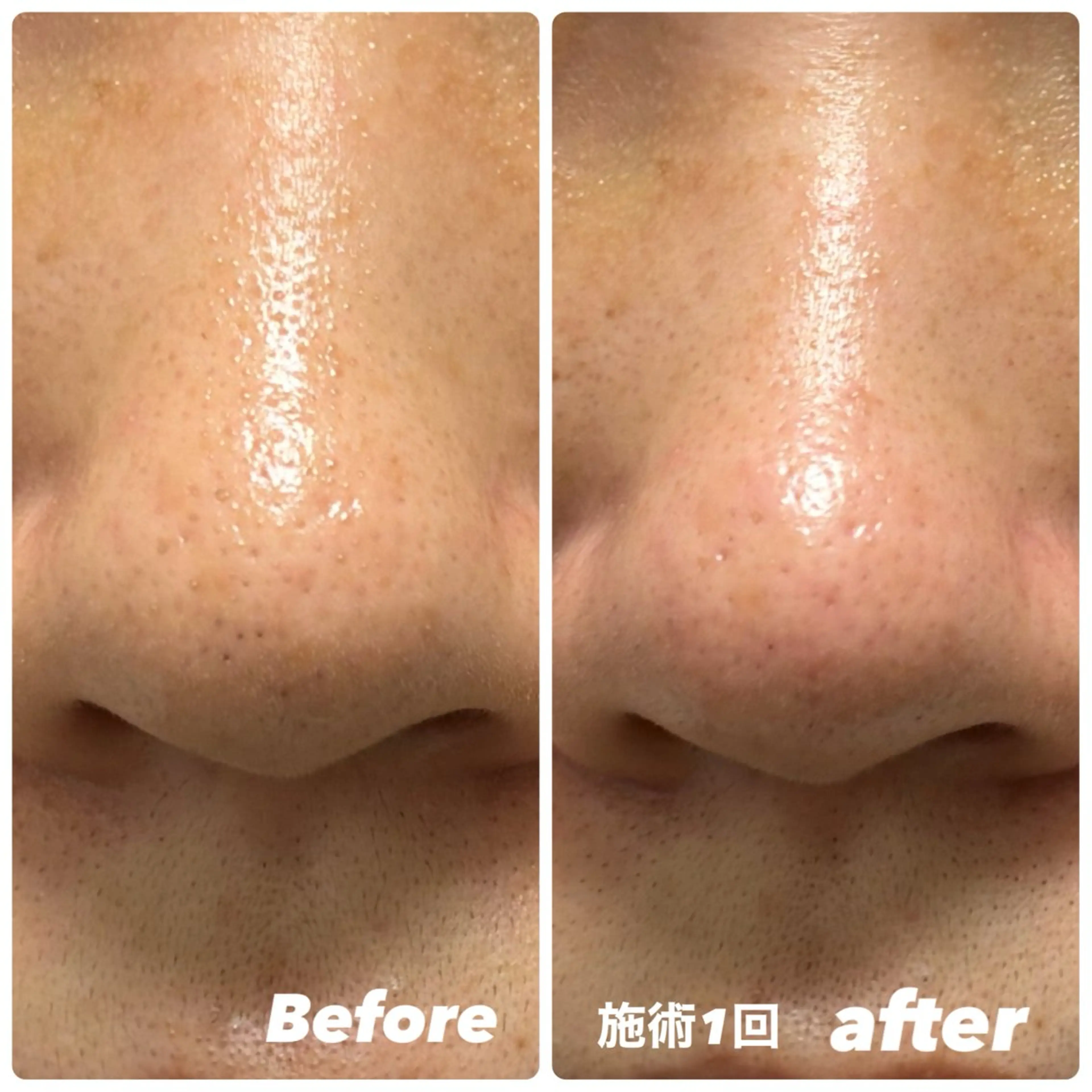 角栓除去＆毛穴エクストラクションの写真