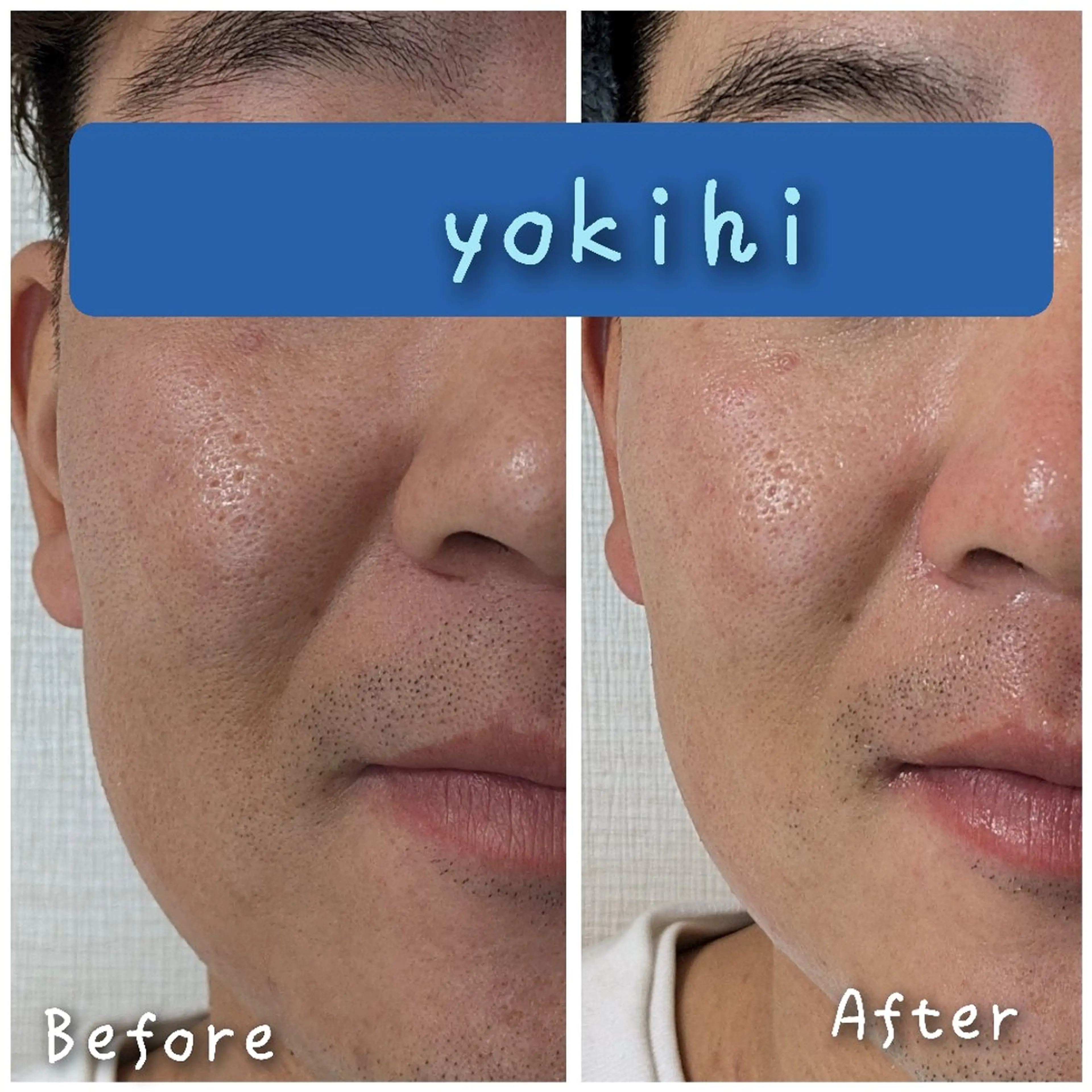 エステ 結果が出るスキンケア 肌質改善/まつパのエステ・リラクイメージ