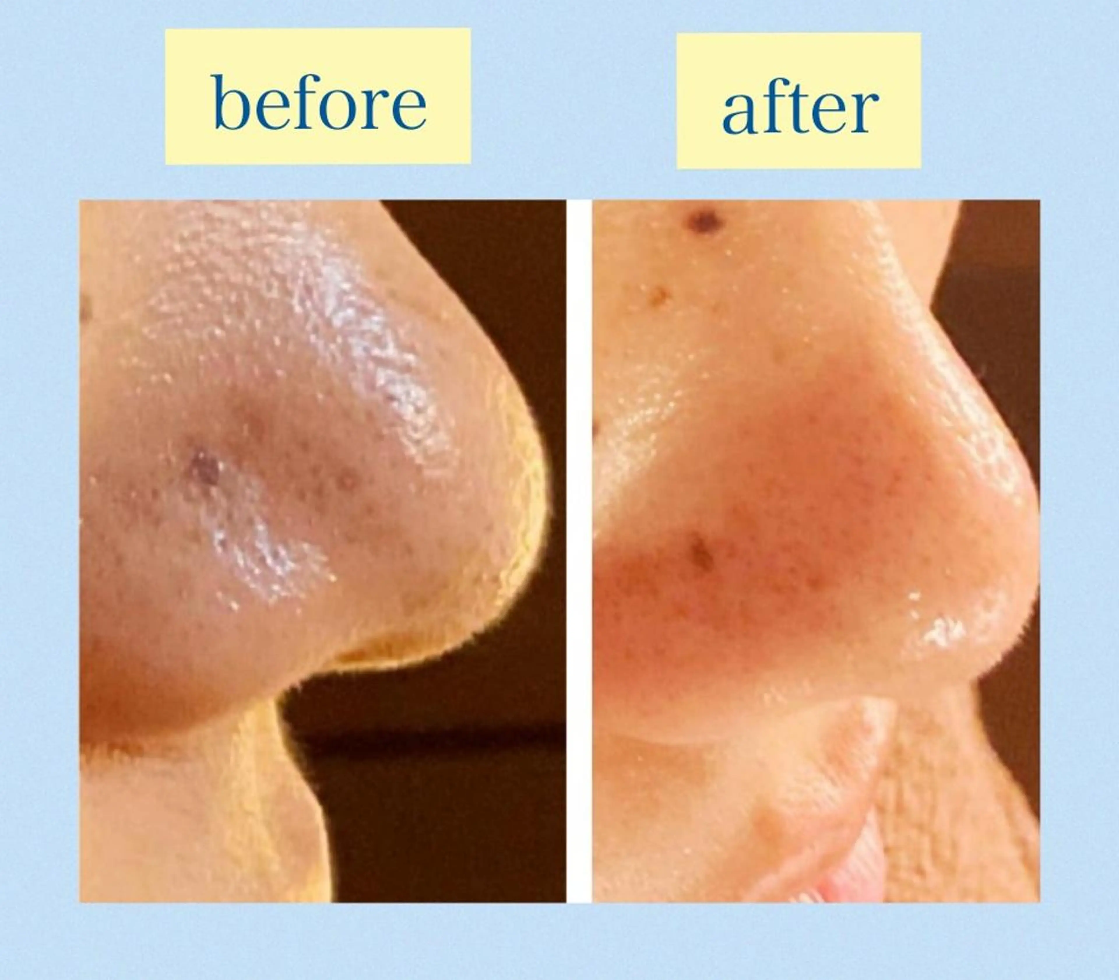 【初回限定】ハイドロフェイシャル毛穴洗浄コースの写真