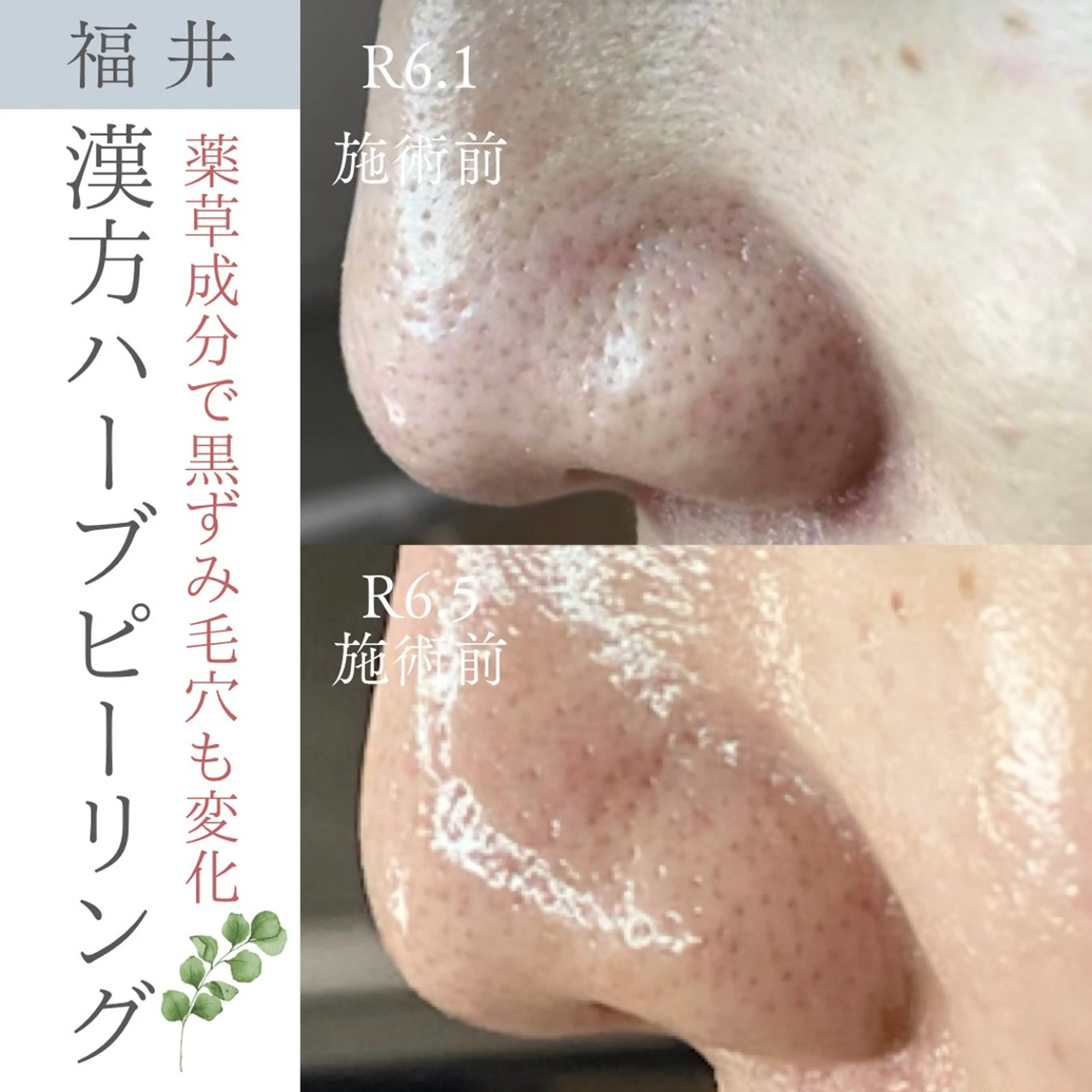 【ミニモ学割15%OFF】国産漢方ハーブピーリング通常¥11000の写真