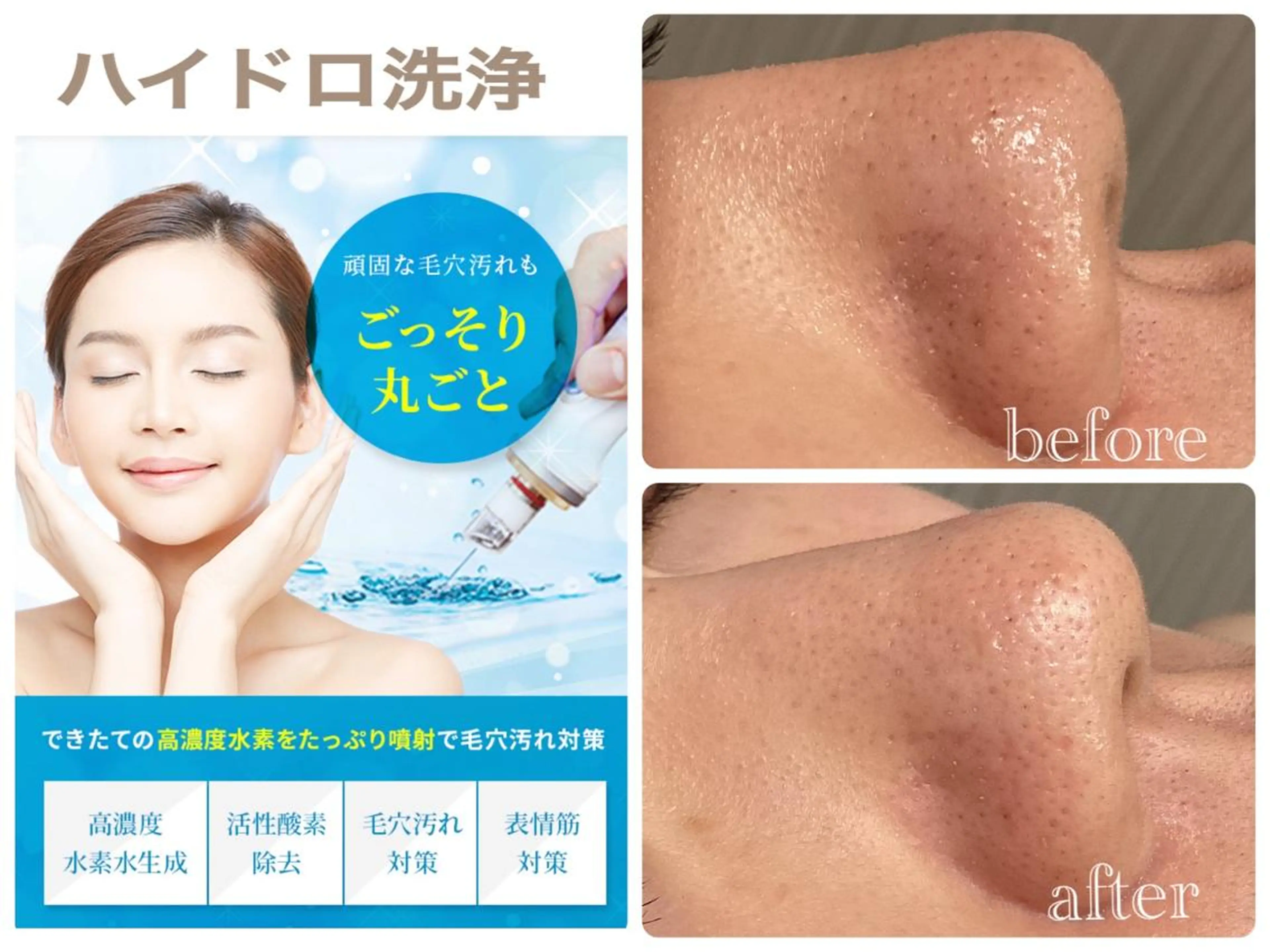 大人気‼毛穴を水素の力でジェット洗浄&美容液導入ハイドロフェイシャル　¥8800の写真