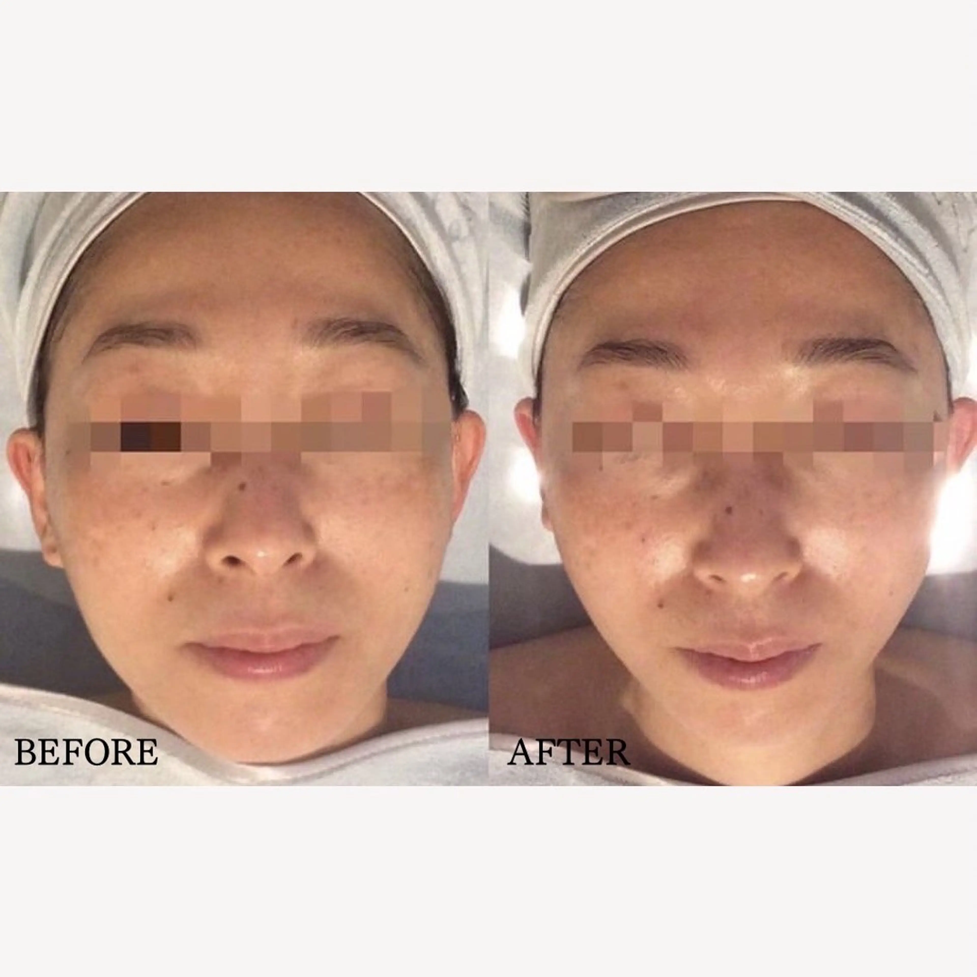 【人気No. 1⭐︎小顔/たるみ凹凸ケア】お試しサーマトリックス選べるパーツ３部位✨の写真