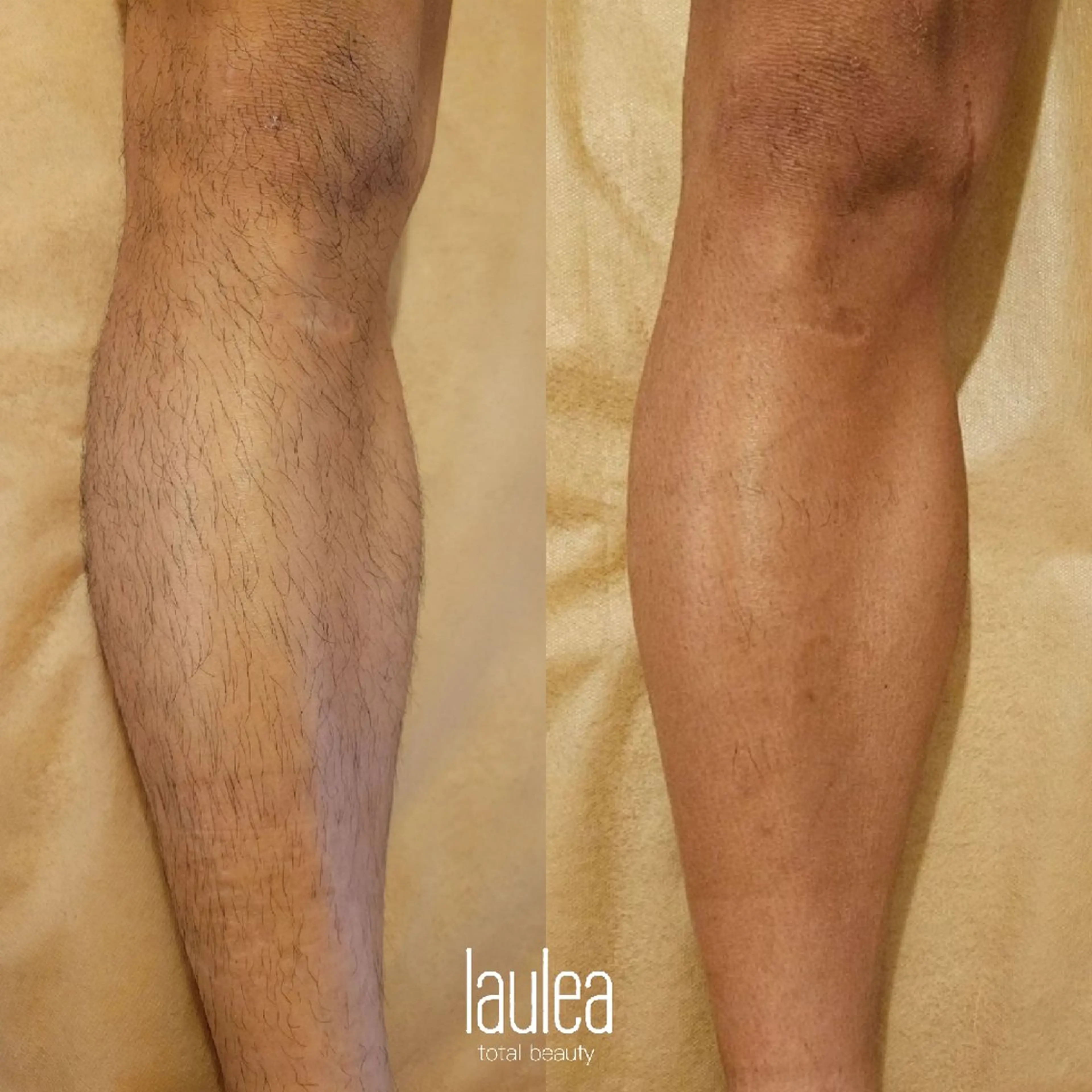 人気メニュー♪【脱毛】脚全体(太股～指先)の写真