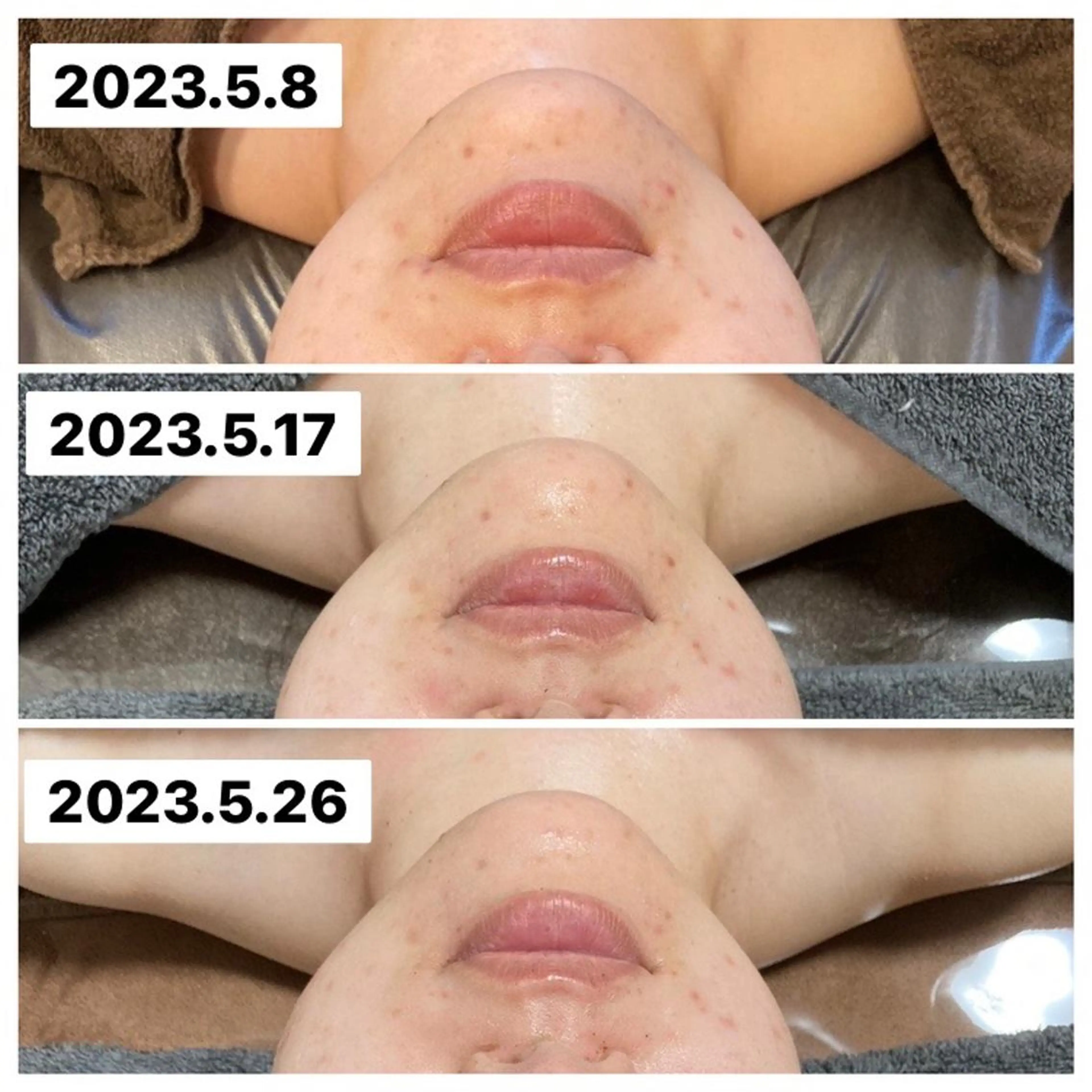 シミ・ニキビケア【顔】の写真