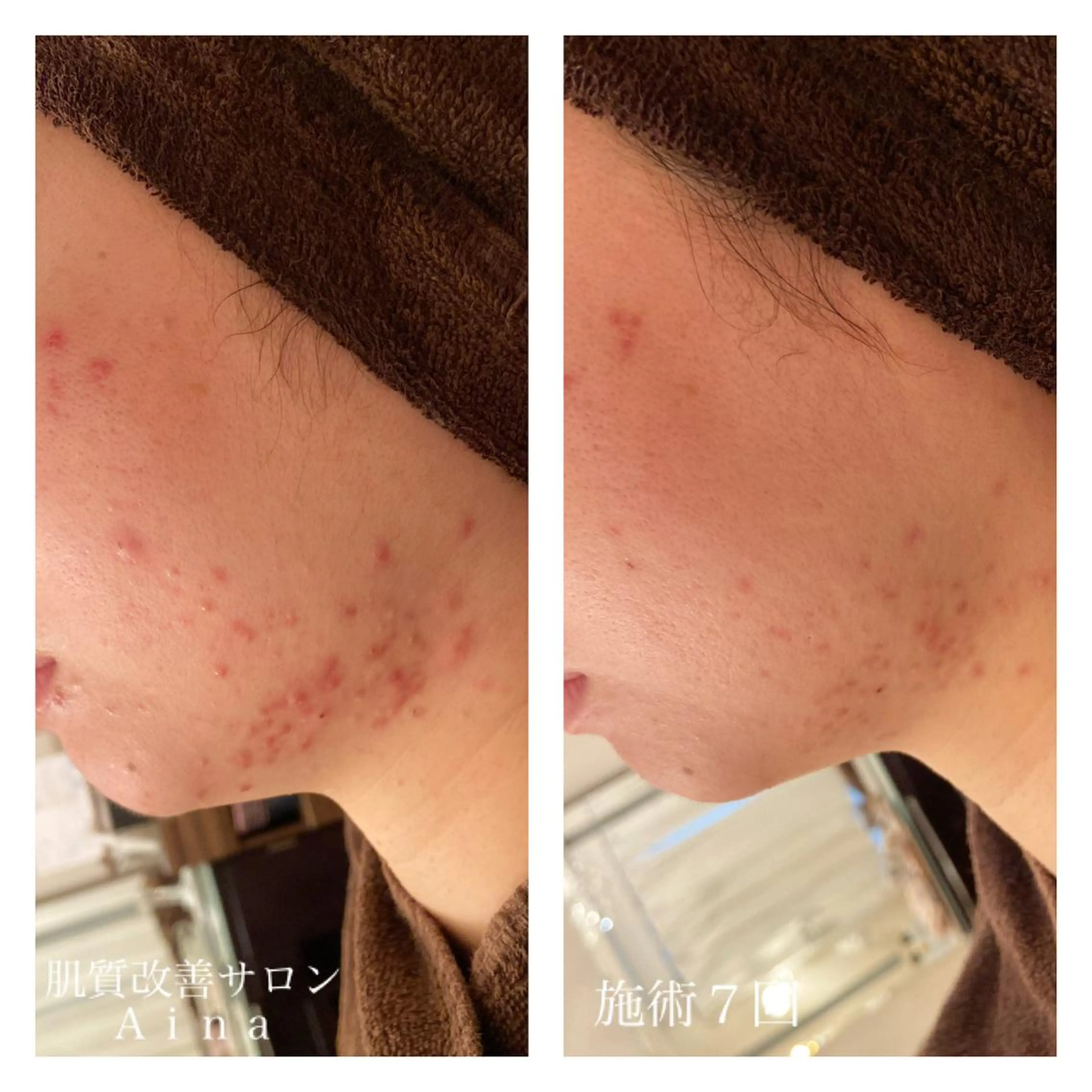 ミディアム カラー パーマ ヘアアレンジ メンズ ネイル マツエク・マツパ 卒業式のヘアスタイル 卒業式 ニキビ跡専門サロン Ainaのエステ・リラクイメージ