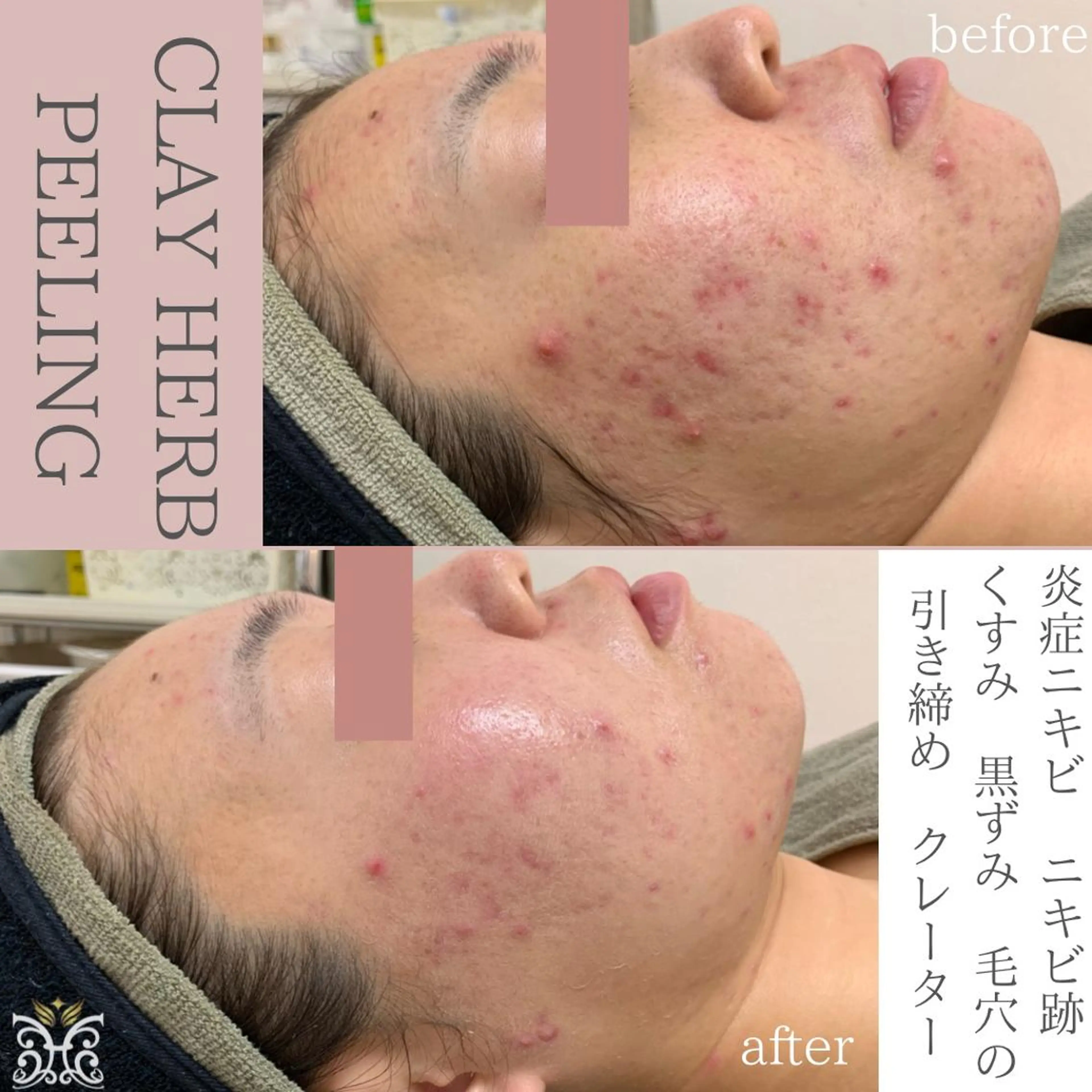 エステ リラク 【剥離ありハーブピーリング専門エステ】cerisier BEAUTÉ 原宿所属・cerisier BEAUTÉのエステ・リラクイメージ