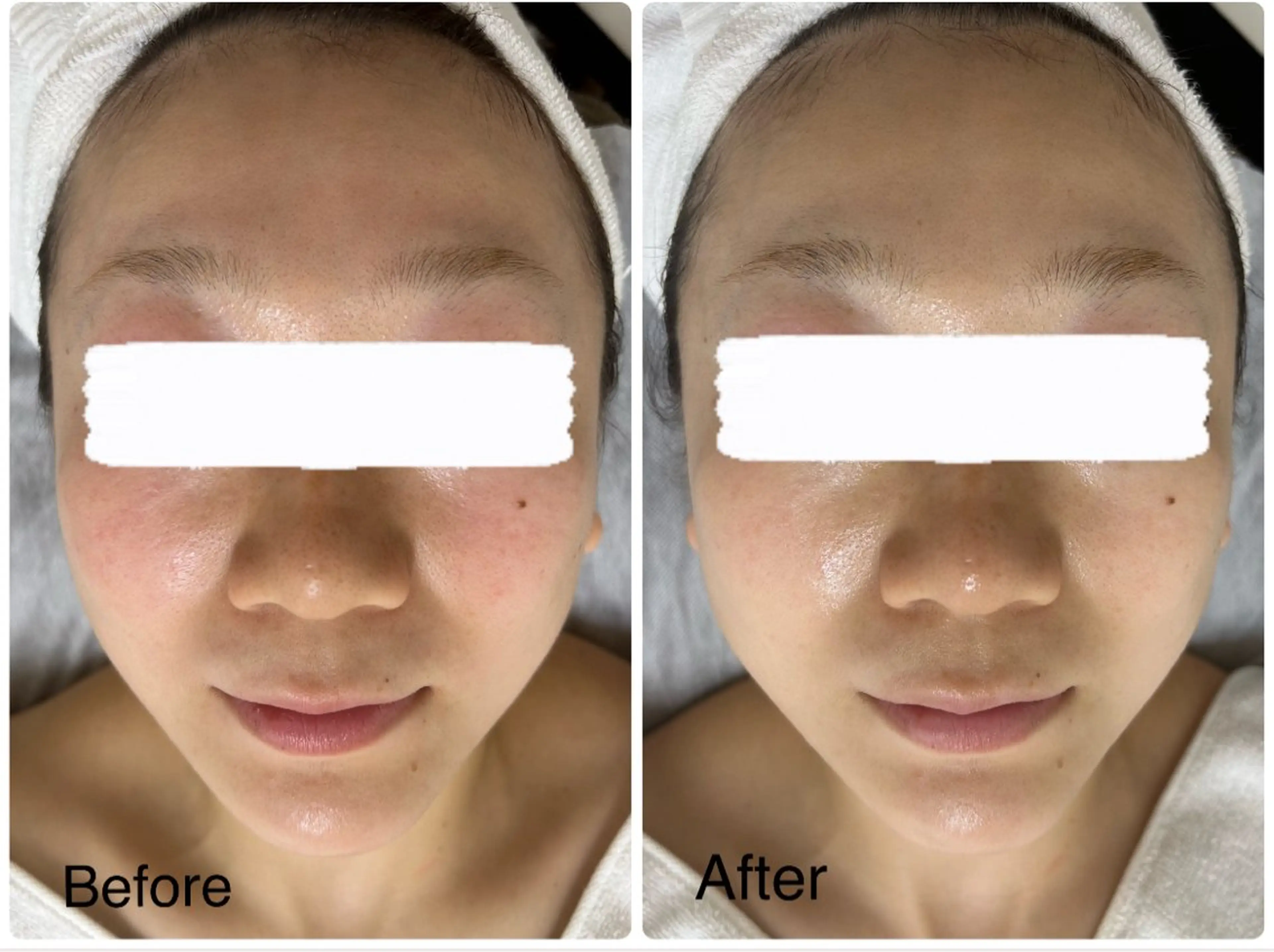 【美肌エステ】デコルテケア付でリラックス！ワンランク上の極上フェイシャルエステ💆‍♀️肌質＆トラブル別パック付き🩷の写真