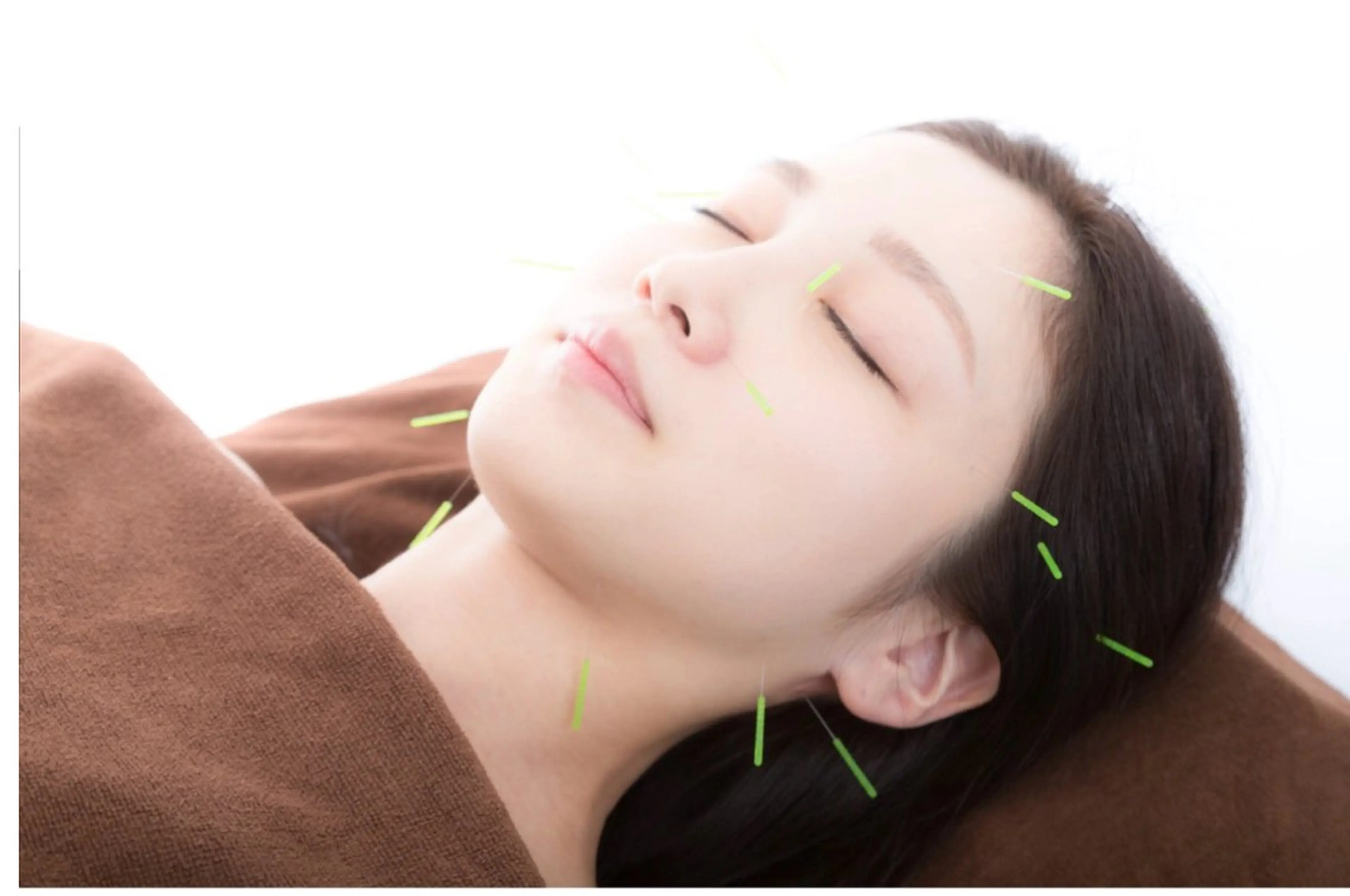 【初めてのあなたにオススメ】✨若見えメリハリ小顔に✨【小顔リフトアップ美容鍼】たるみ/シワ/ほうれい線にオススメ♪の写真