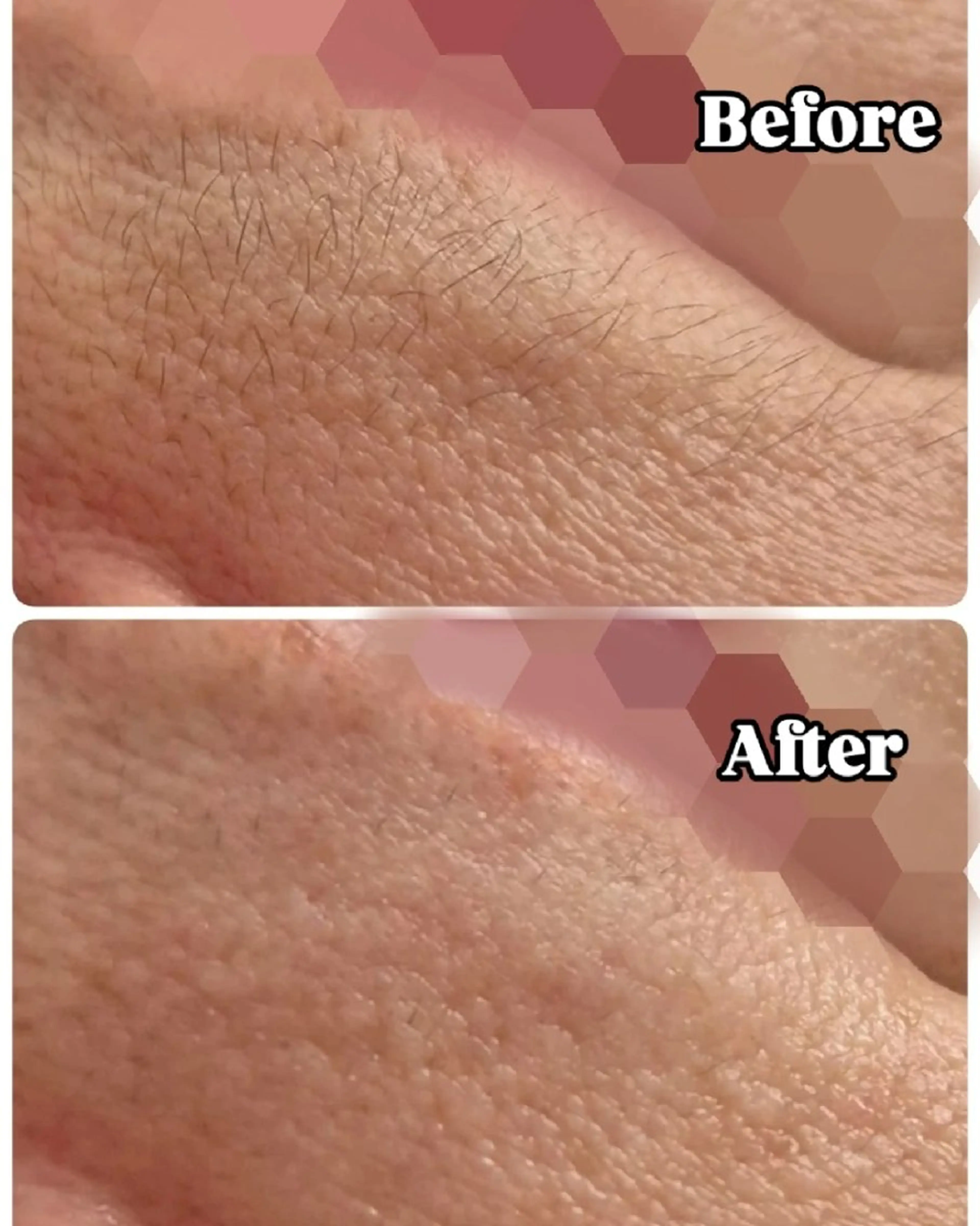 つるん肌ෆ ̖́-フェイスワックス脱毛の写真