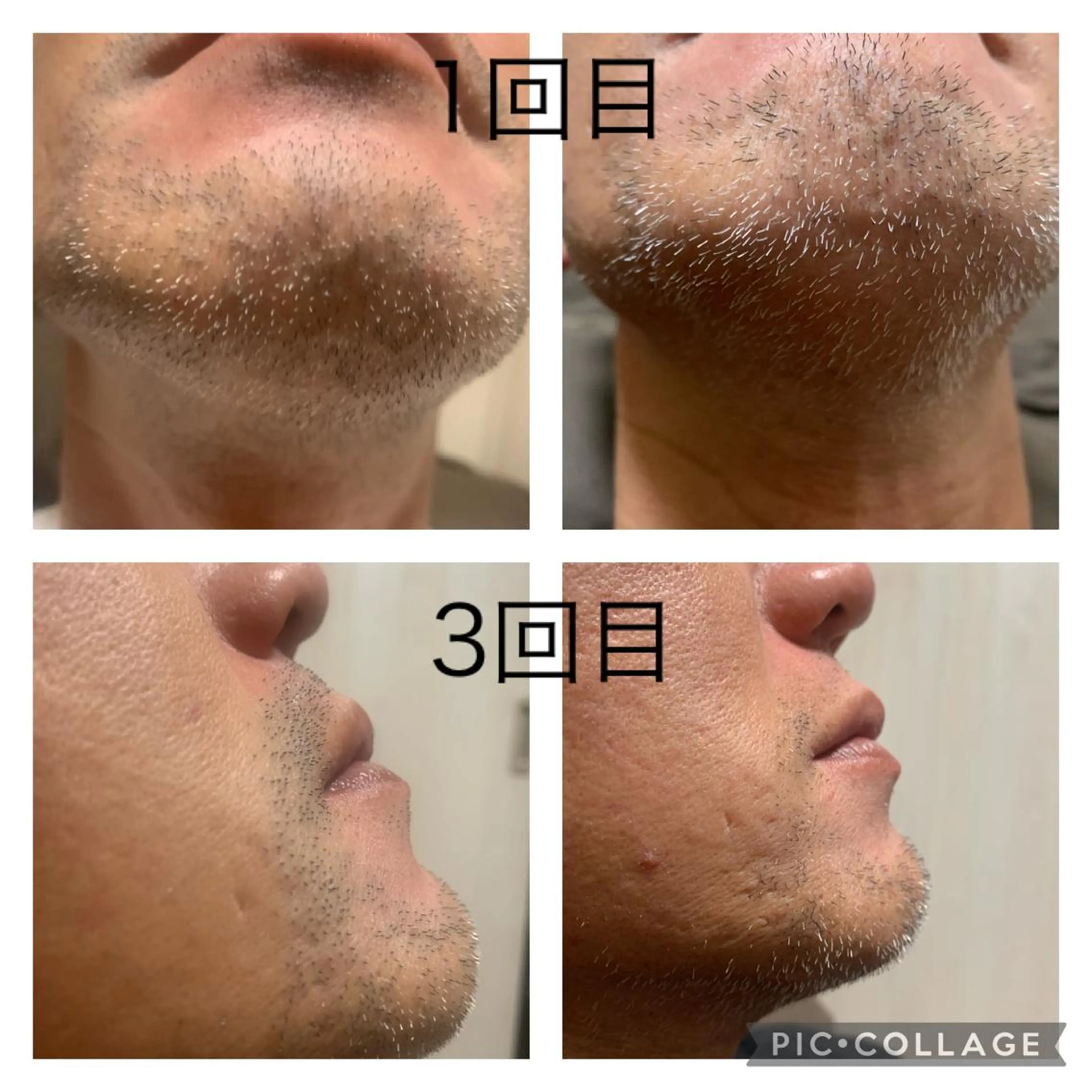 ヒゲ脱毛(男性)の写真