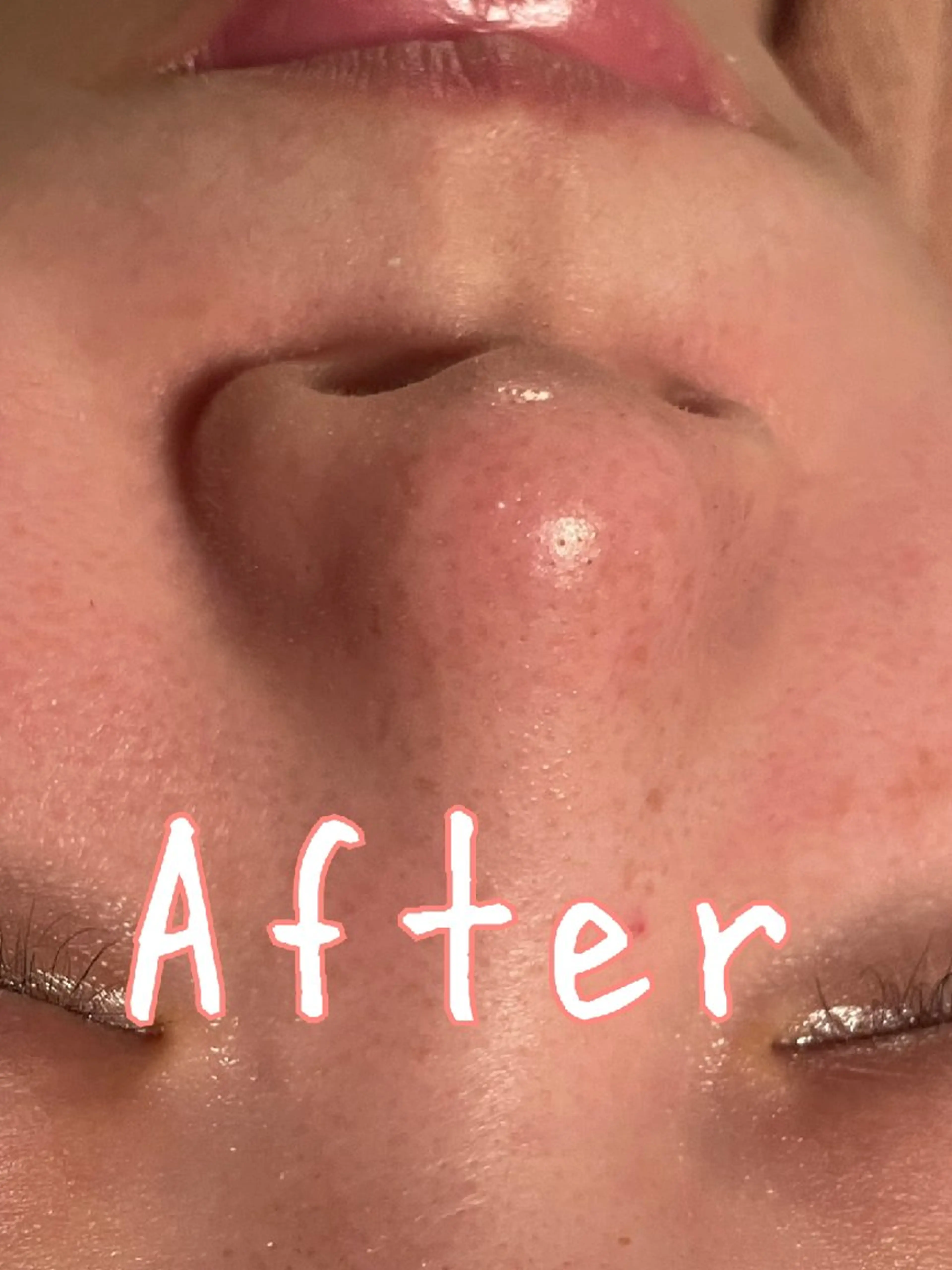 毛穴洗浄フェイシャルの写真