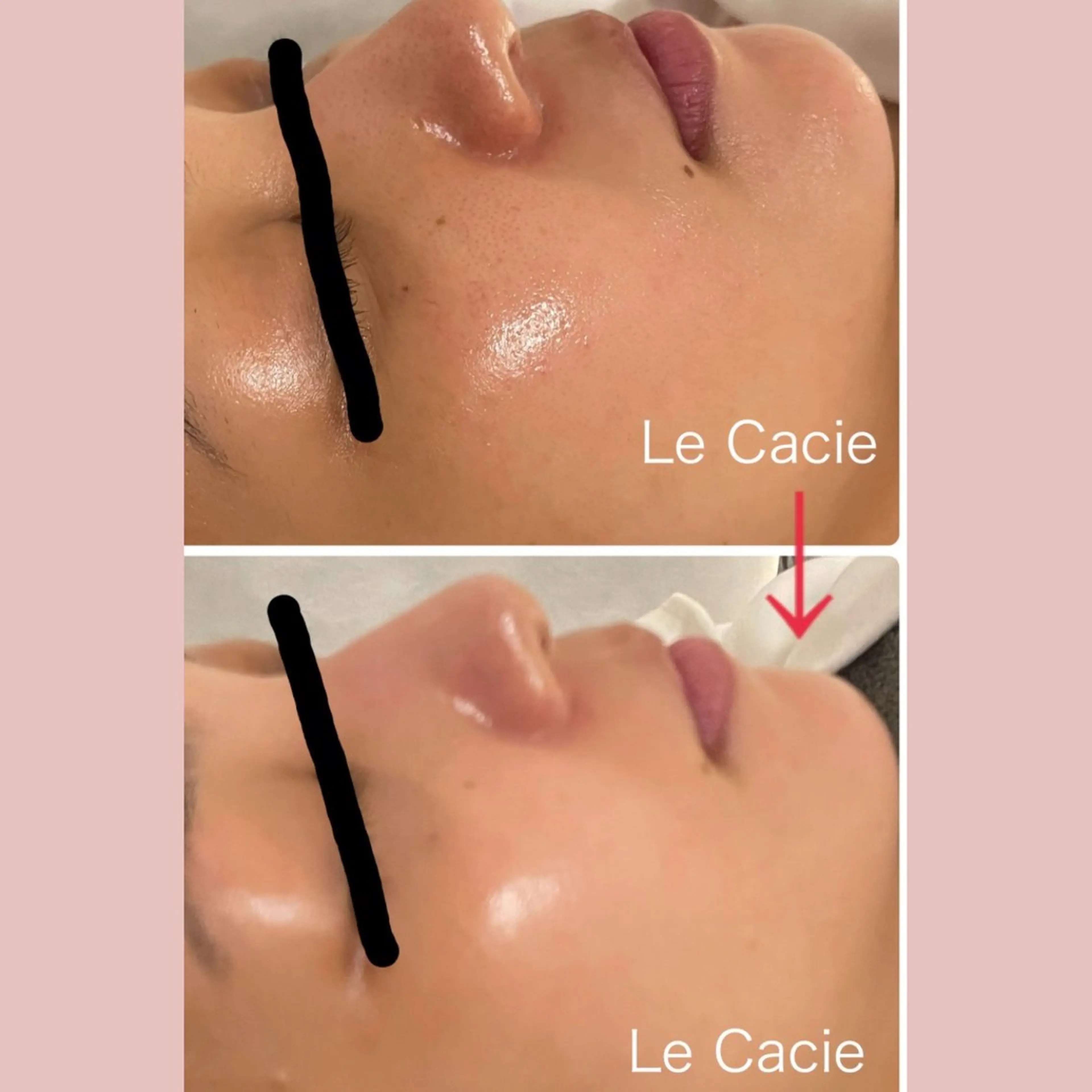 【くすみ、色むら、シミ改善】トラネキサム酸&グルタチオン★ポレーション導入フェイシャル/深層ピーリング付きの写真