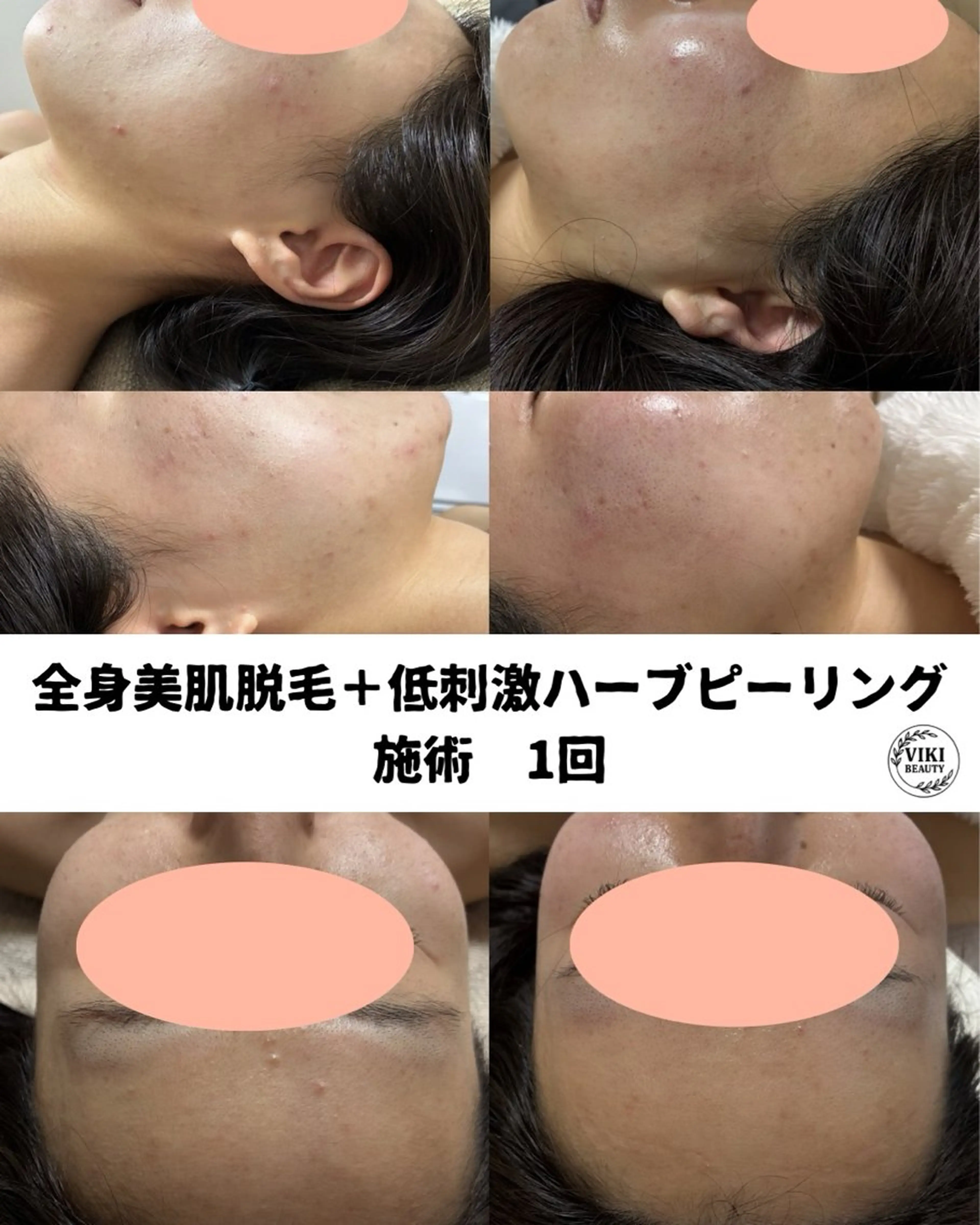 VIKI BEAUTY  クレイハーブピーリング・美肌脱毛専門店所属・VIKI BEAUTYのエステ・リラクイメージ