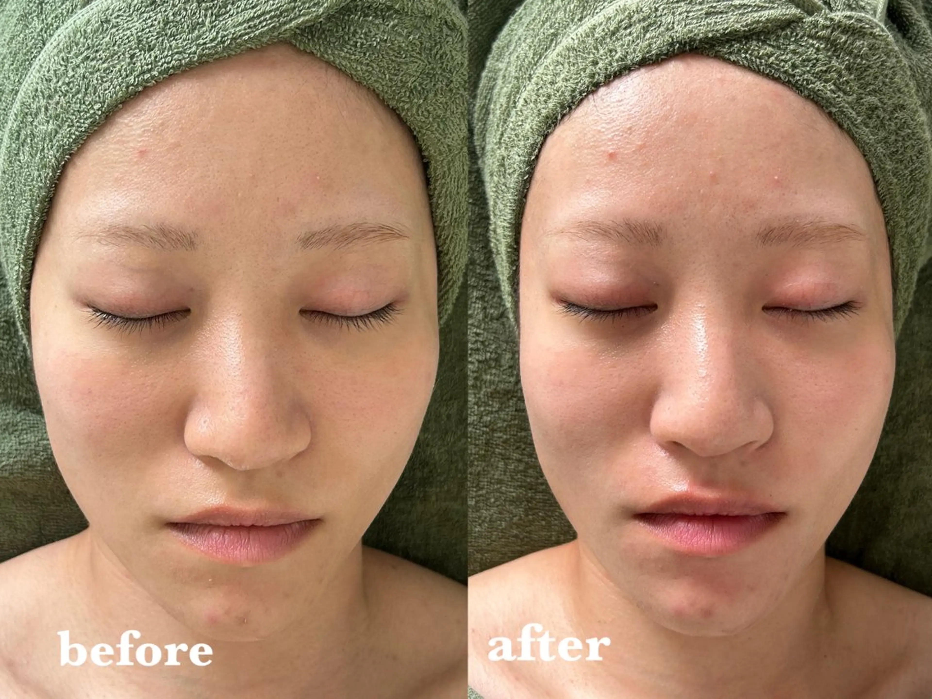 【たるみ･浮腫み・小顔効果】陶肌トリートメント▶¥8,800(陶肌パウダー1ｇプレゼント価格)の写真