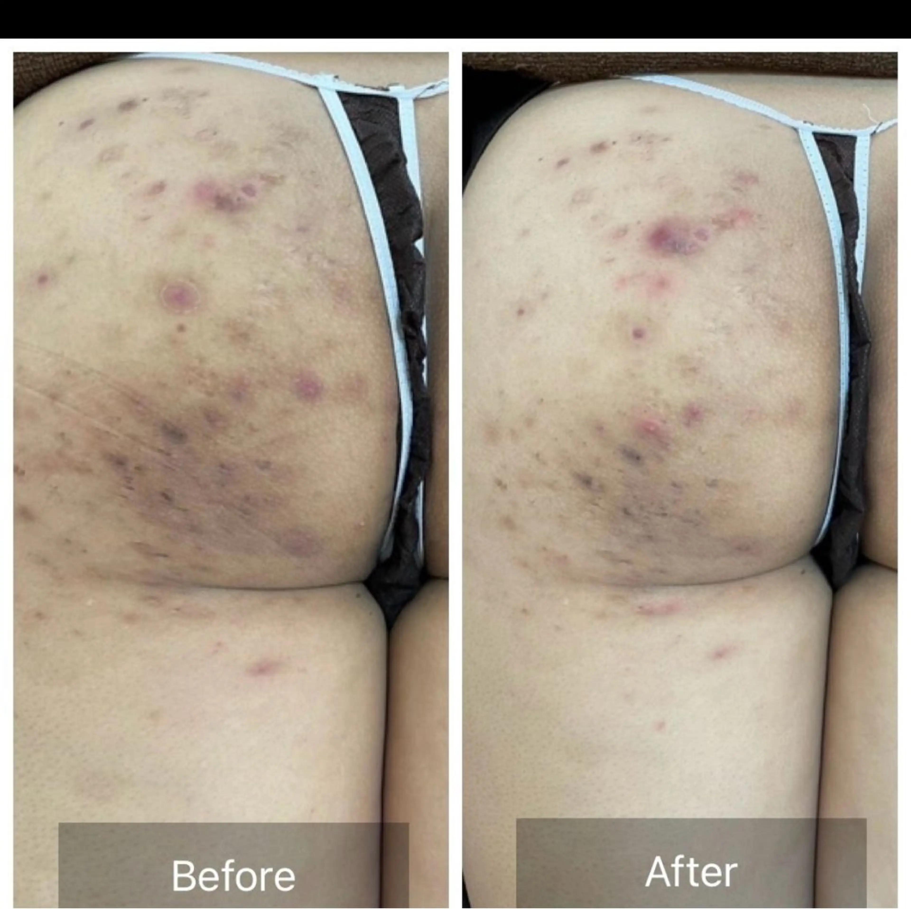 つるんとした美尻へ🍑ハーブピーリング剥離有り・無し選べます😆通常¥22,000円→初回お試し価格9,800円の写真