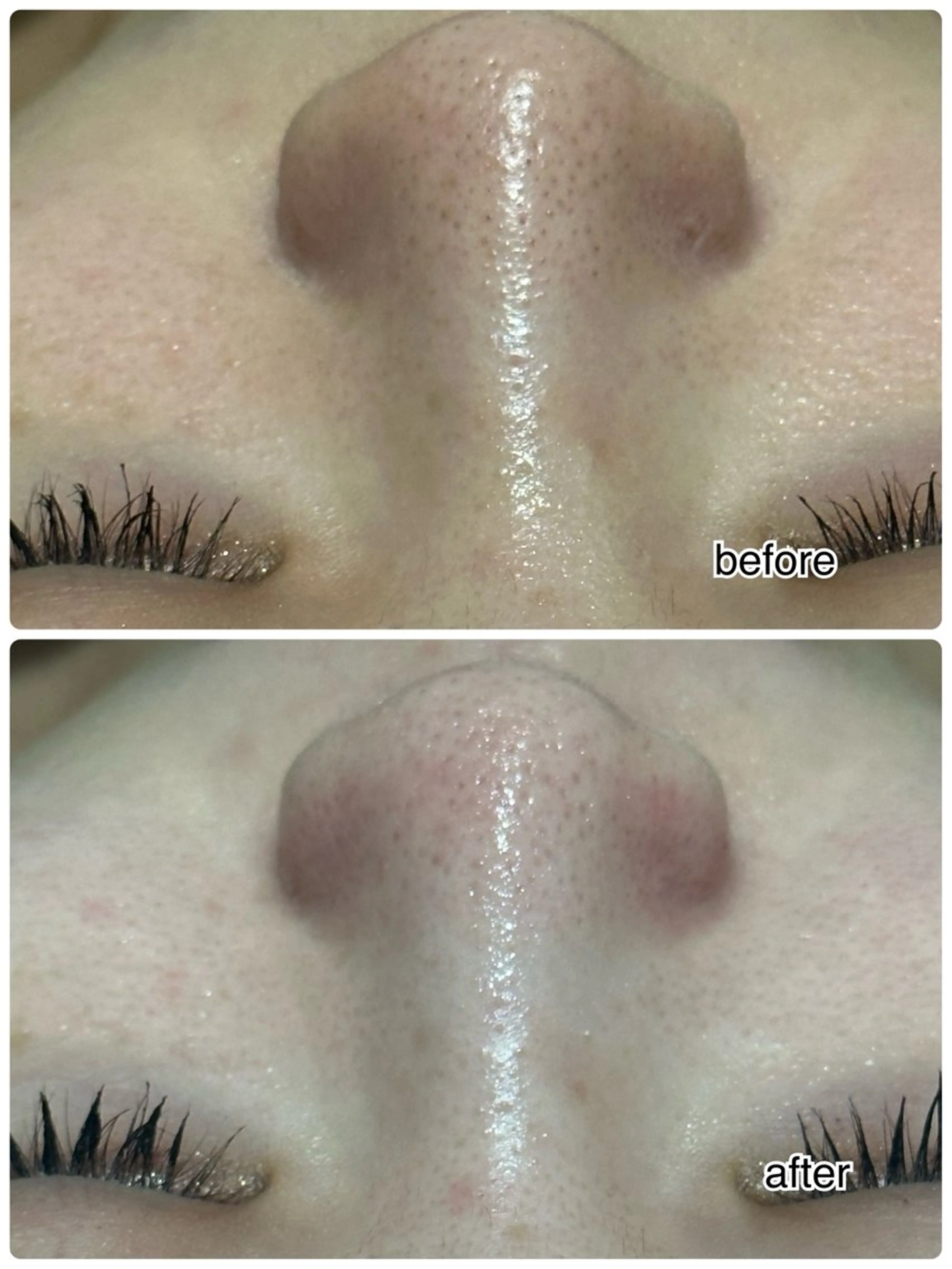 日にち、時間限定！ハイドラフェイシャル★【頑固な黒ずみごっそり！】毛穴洗浄×ヒト幹細胞＆ラジオ波の写真