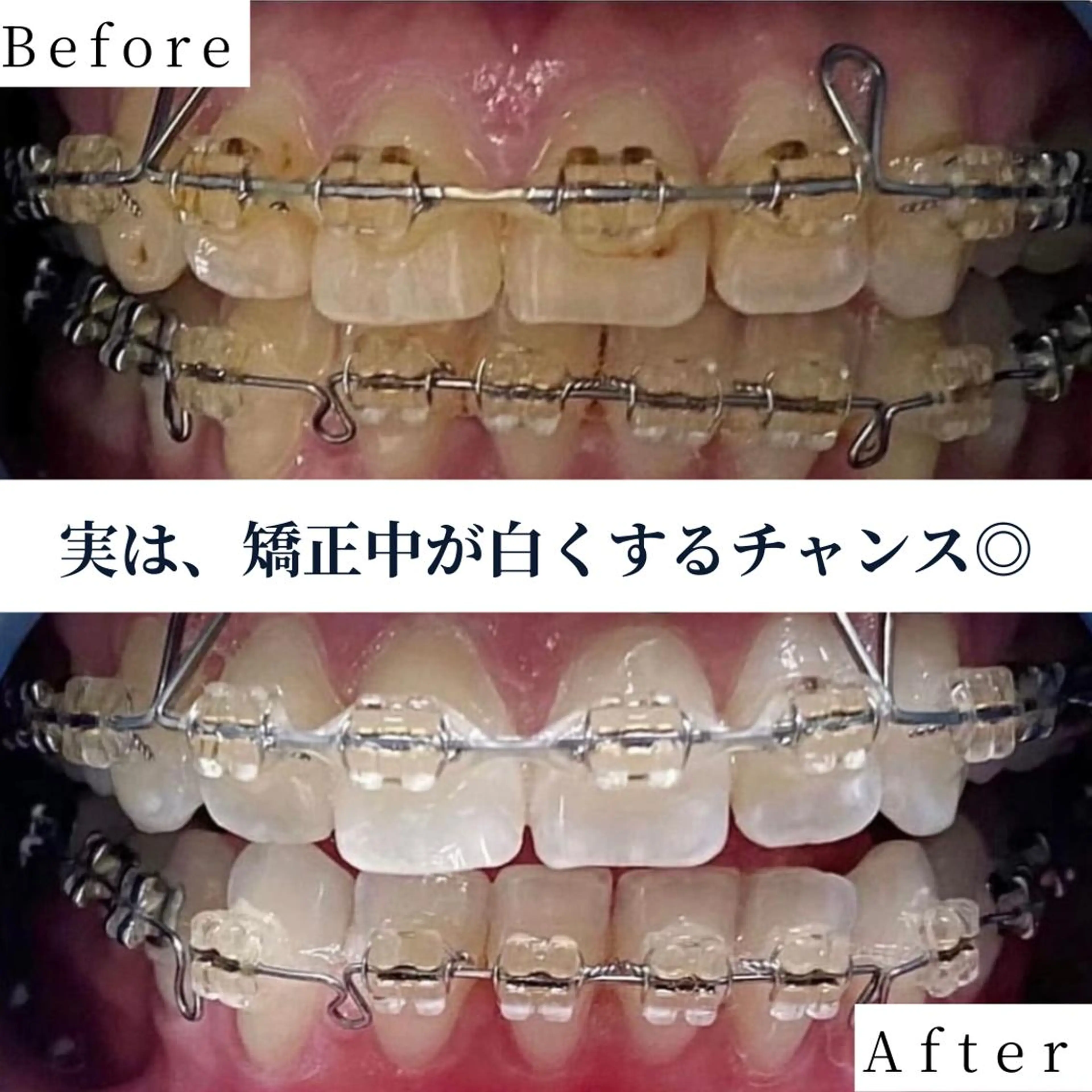 【💖短期間集中💖】ライトコース 40分照射×3回 ¥20000の写真