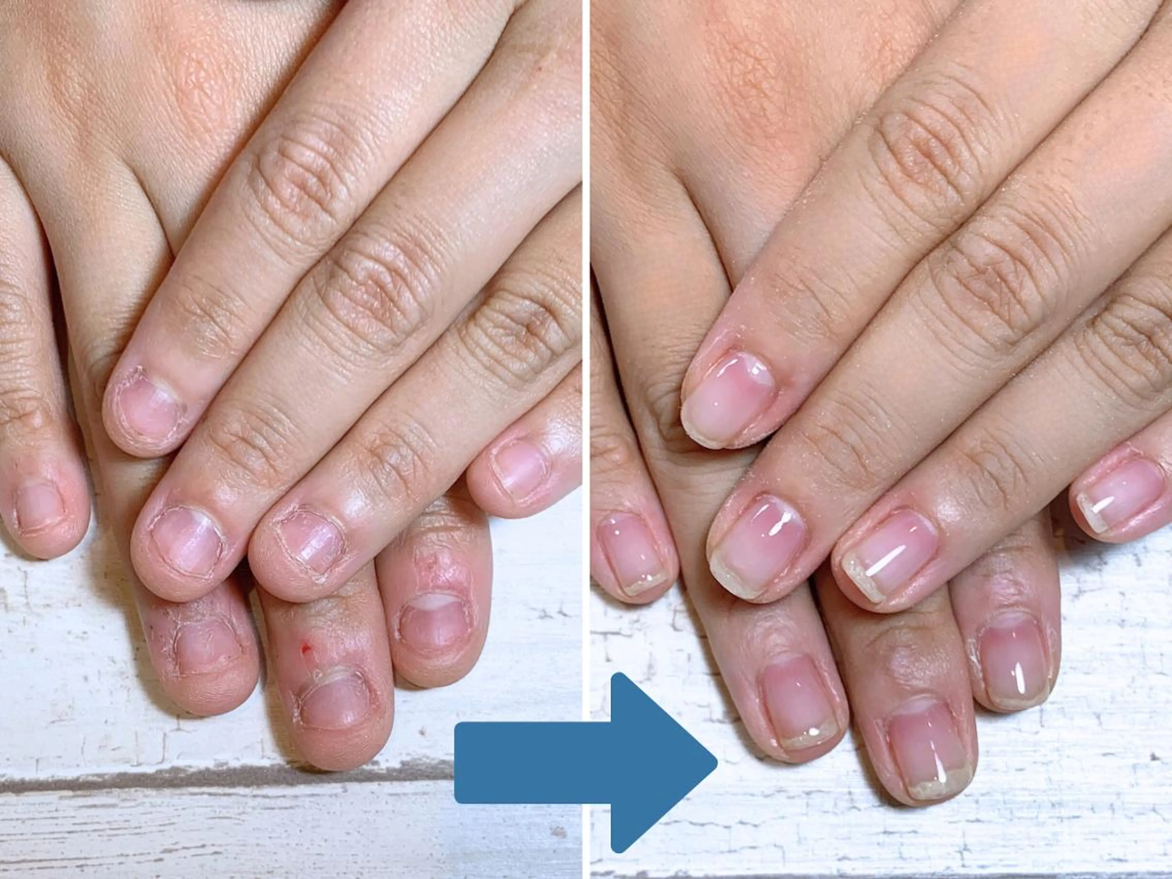 ネイル 深爪矯正・自爪育成 ネイルサロンアモまいのネイルデザイン