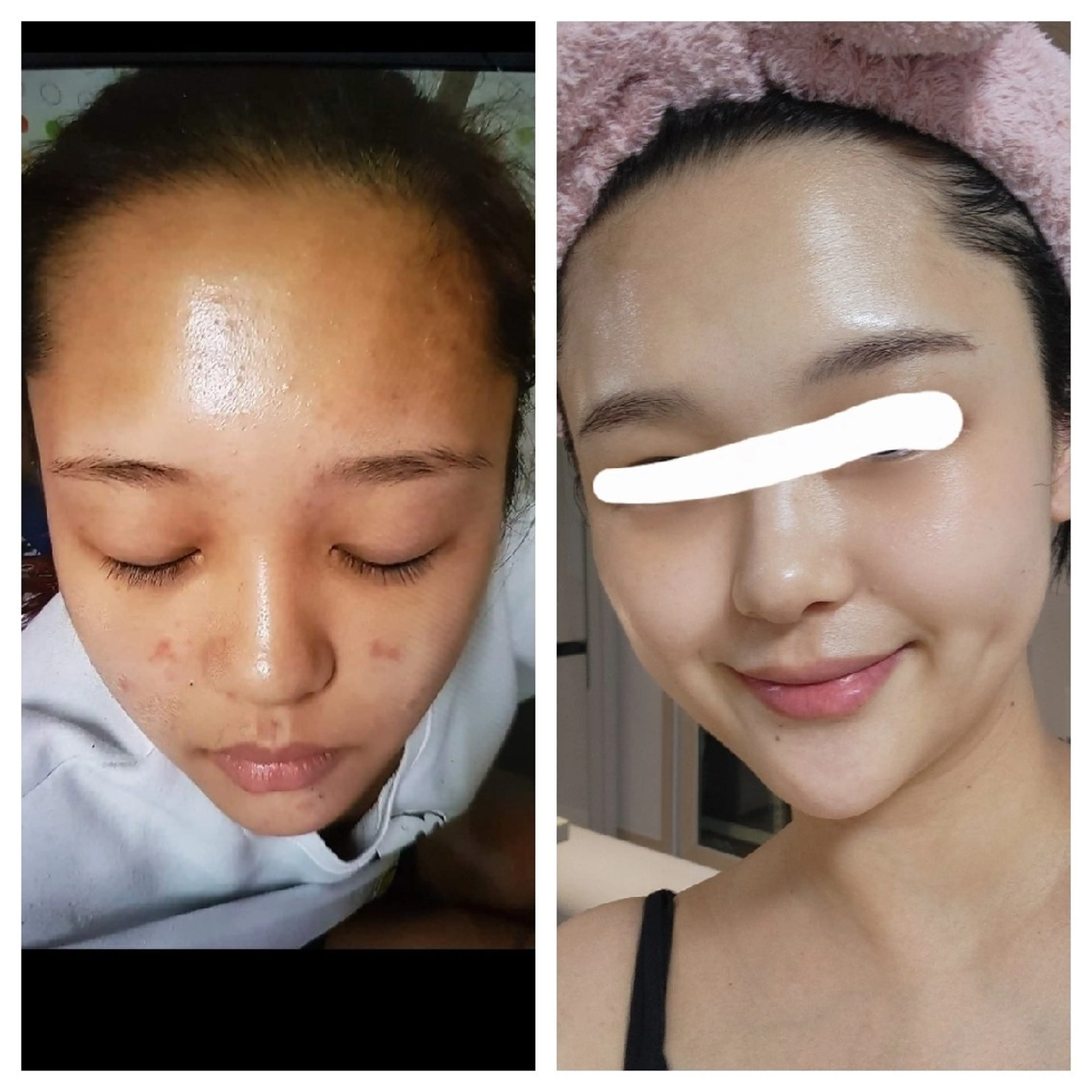 ニキビでお悩みの方限定✨️ニキビの原因を改善！の写真