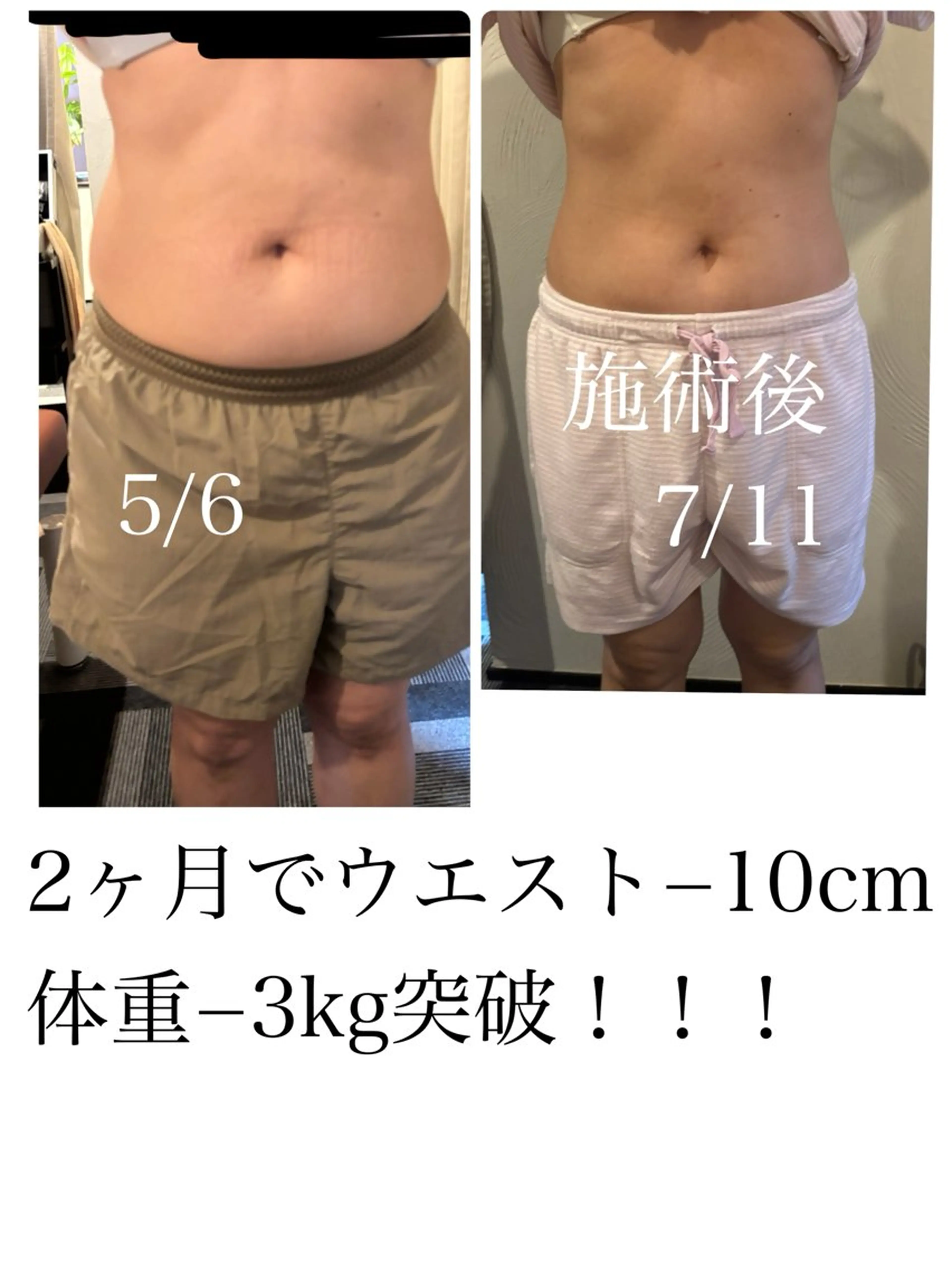 ウエストのみ🌈キャビテーション+オイルトリートメント🌈ご新規様お試し価格✨の写真