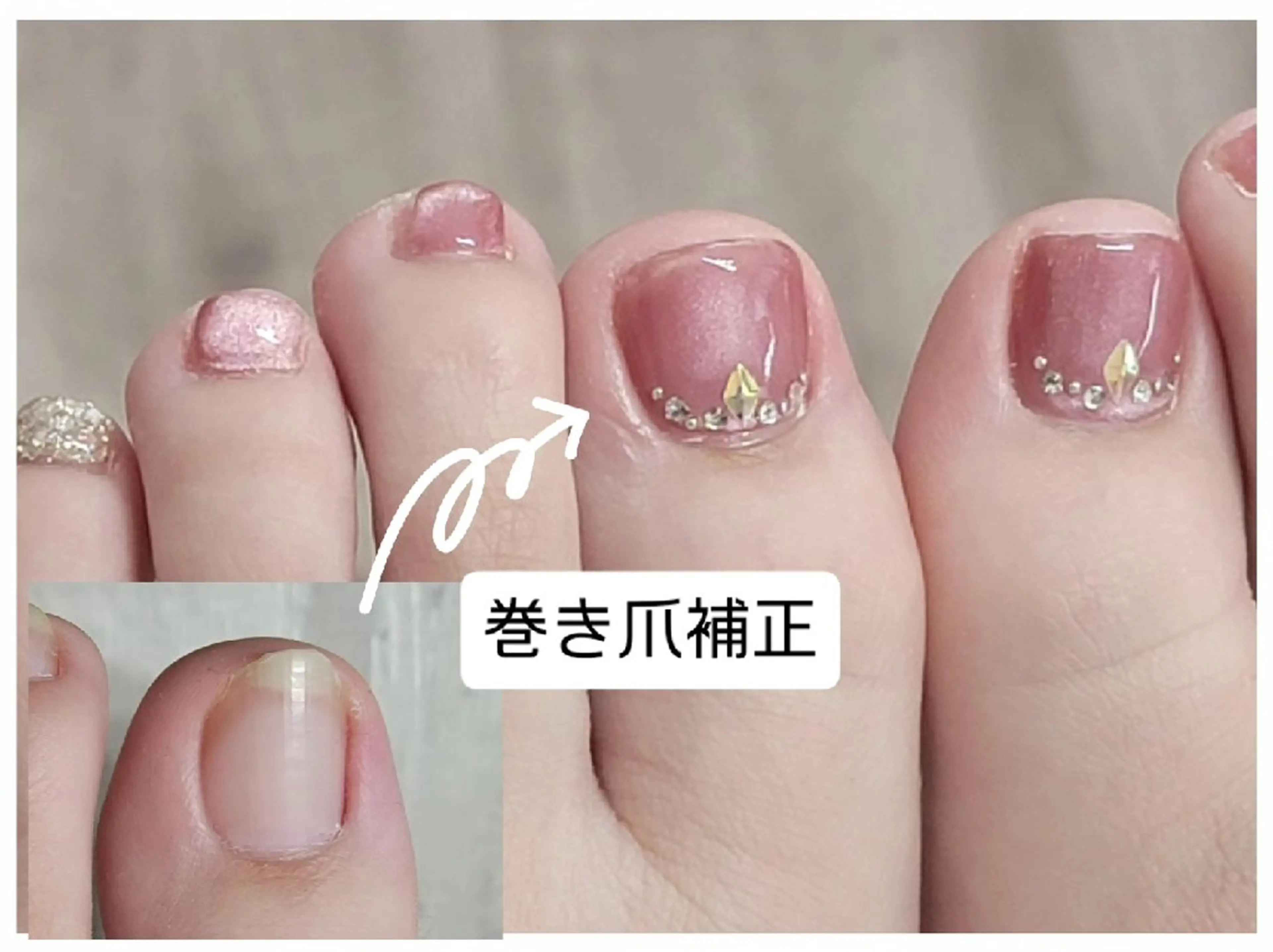 ネイル フットネイル ジェルネイル ネイル&巻き爪サロン 　AKnailのネイルデザイン