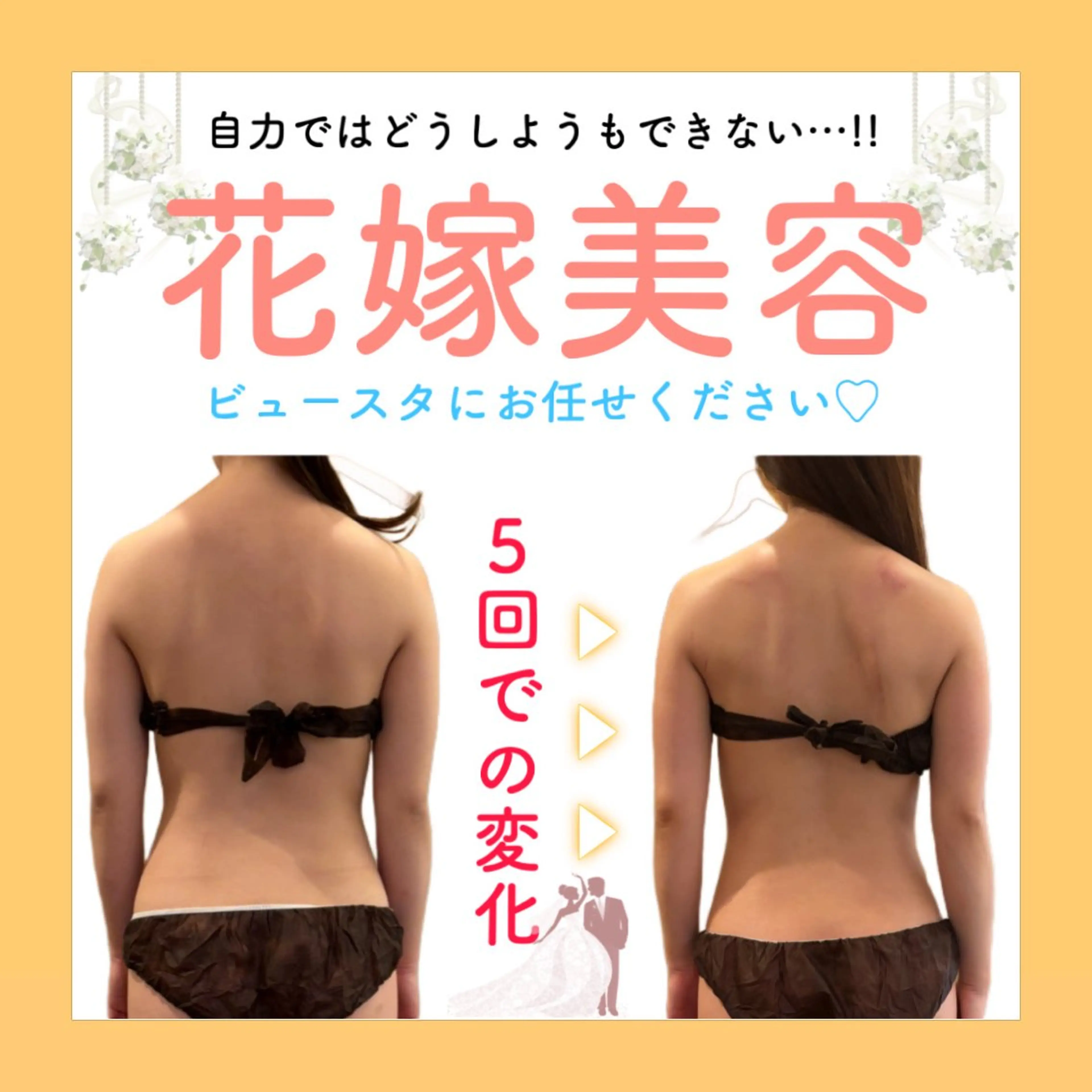 【ブライダル専用】背中の厚み・二の腕痩せはこれ💖ドレスが似合うお身体に劇的変化✨️🤍の写真