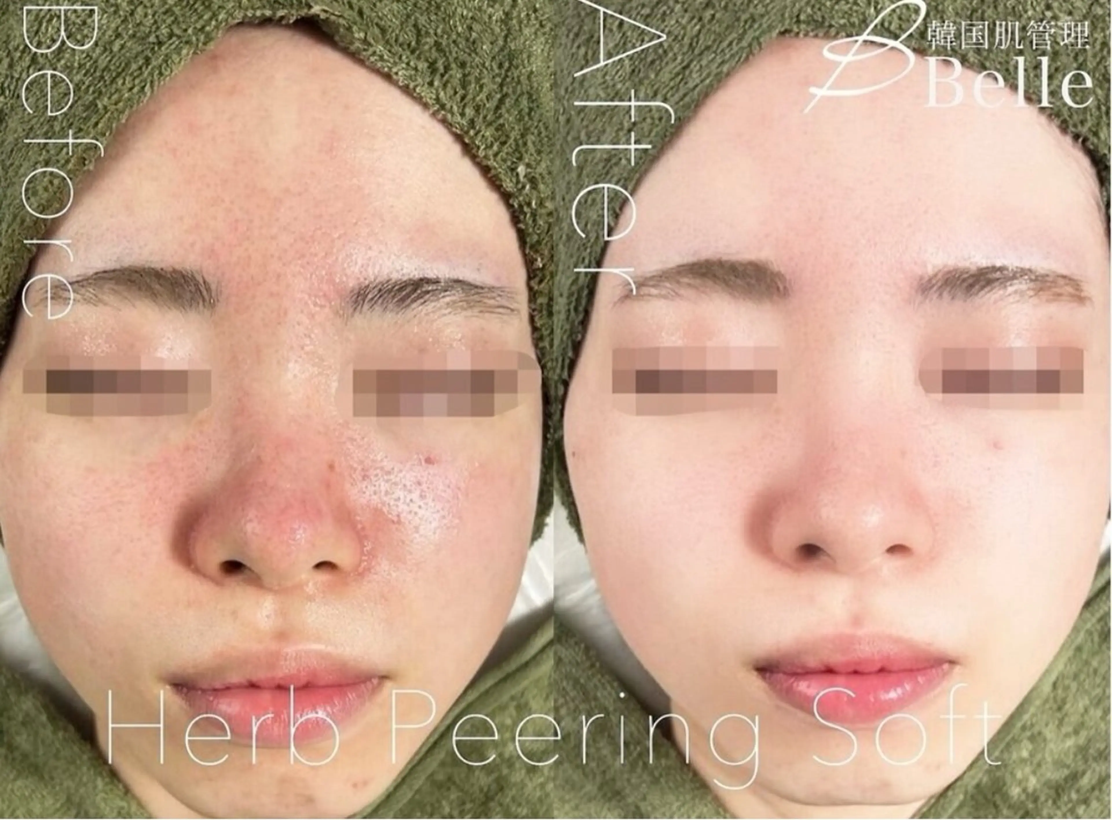 LIME横浜所属・ハーブピーリング🌿 韓国肌管理 Rionのエステ・リラクイメージ