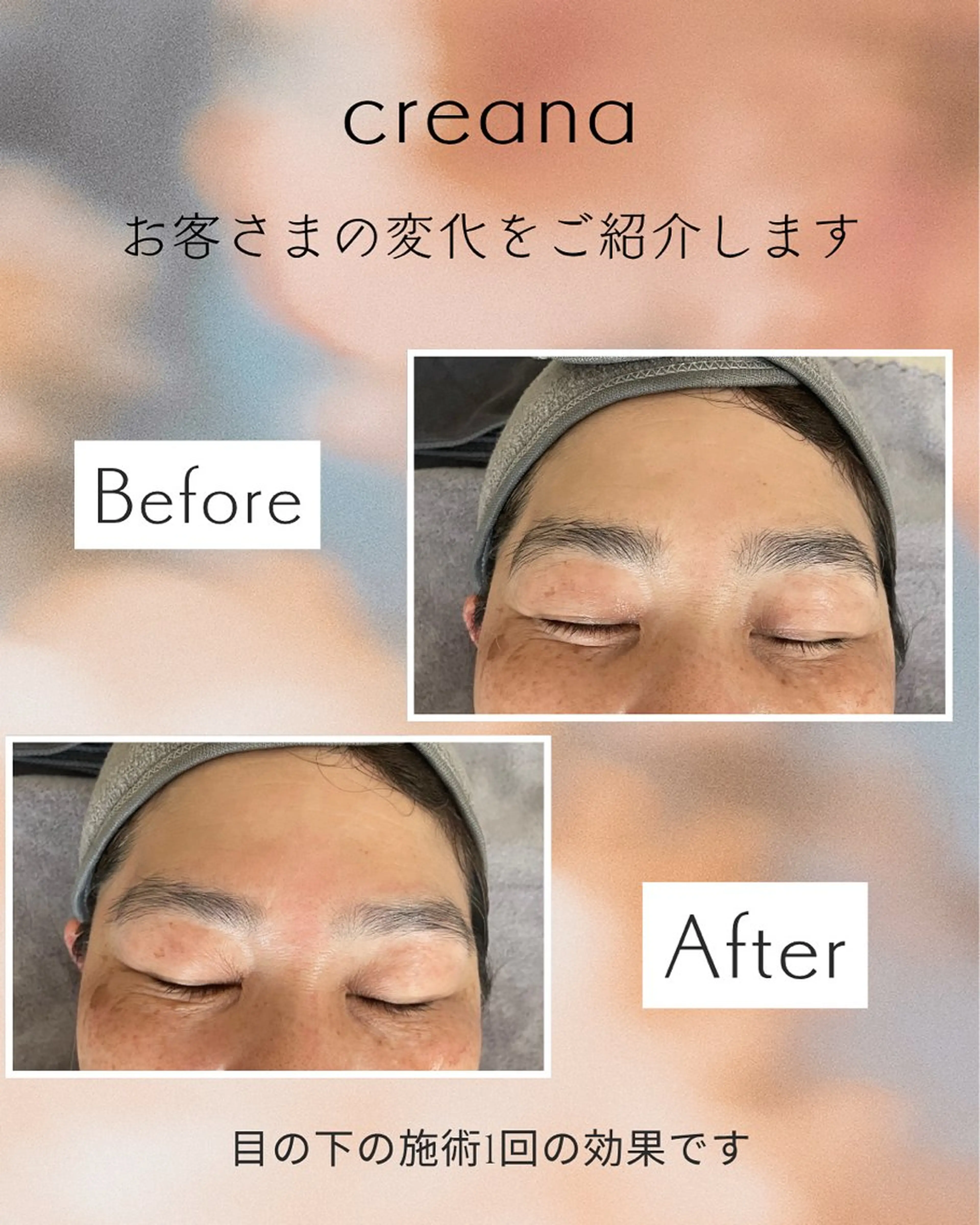 目元くまケアコース（お試し） 🍋レモン (1cc)で目元ケア▶︎シカクリーム＋耳ツボジュエリー(むくみ、血流促進)の写真