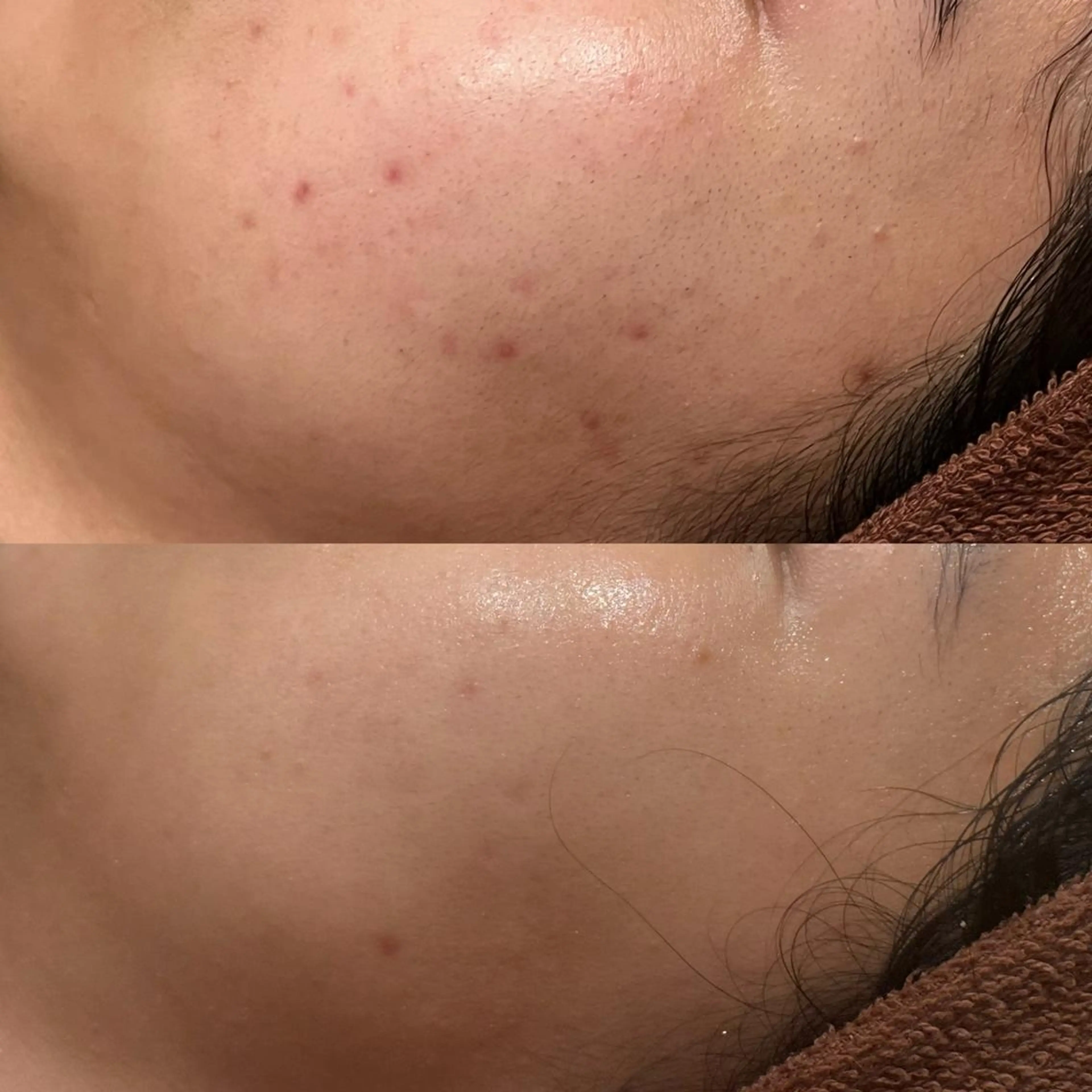 6万人の美肌実績🔥 最短ニキビ改善のエステ・リラクイメージ