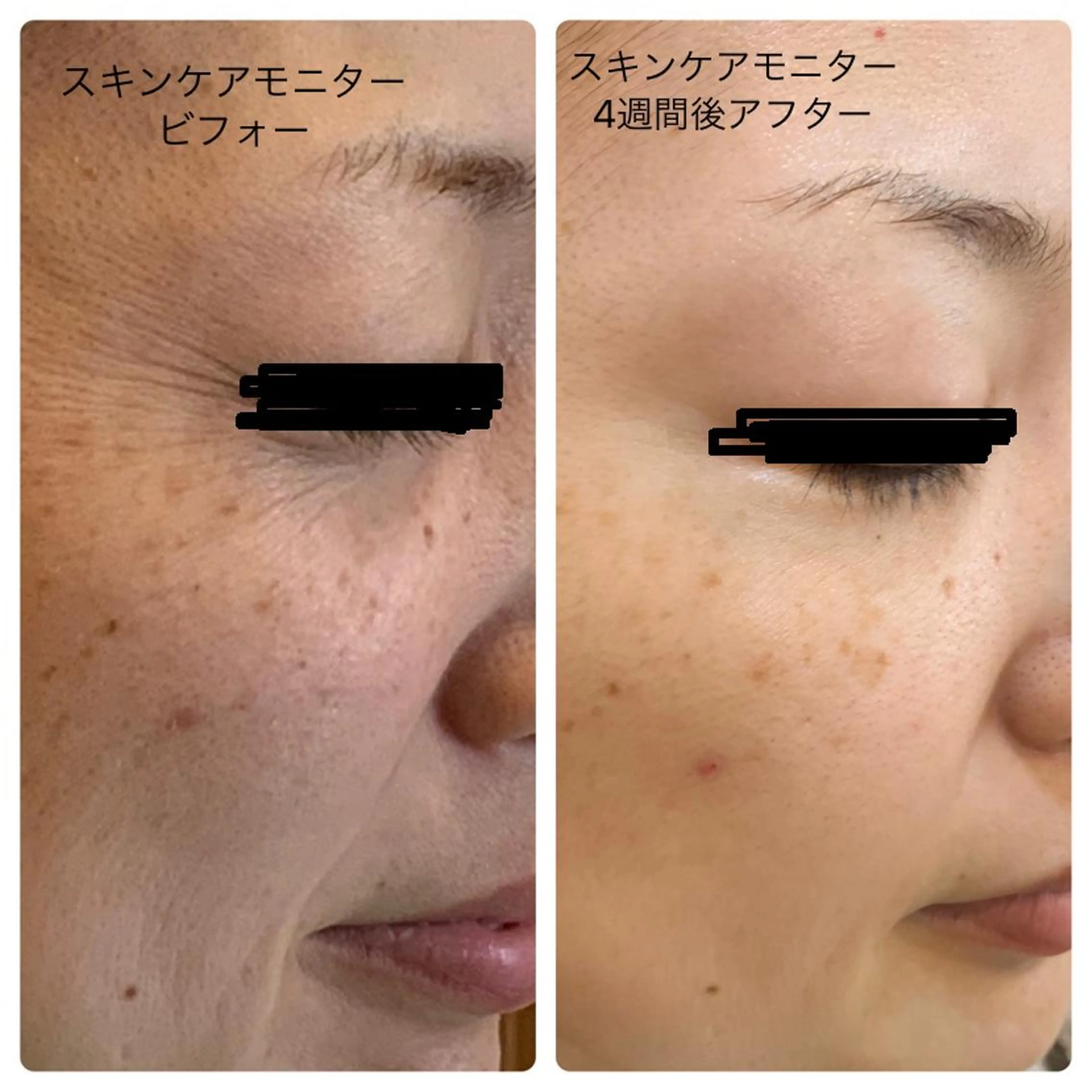 💪肌育プログラム✨エステ4回＋3週間分のホーム用スキンケア付き（洗顔​〜​クリームまで✨）の写真