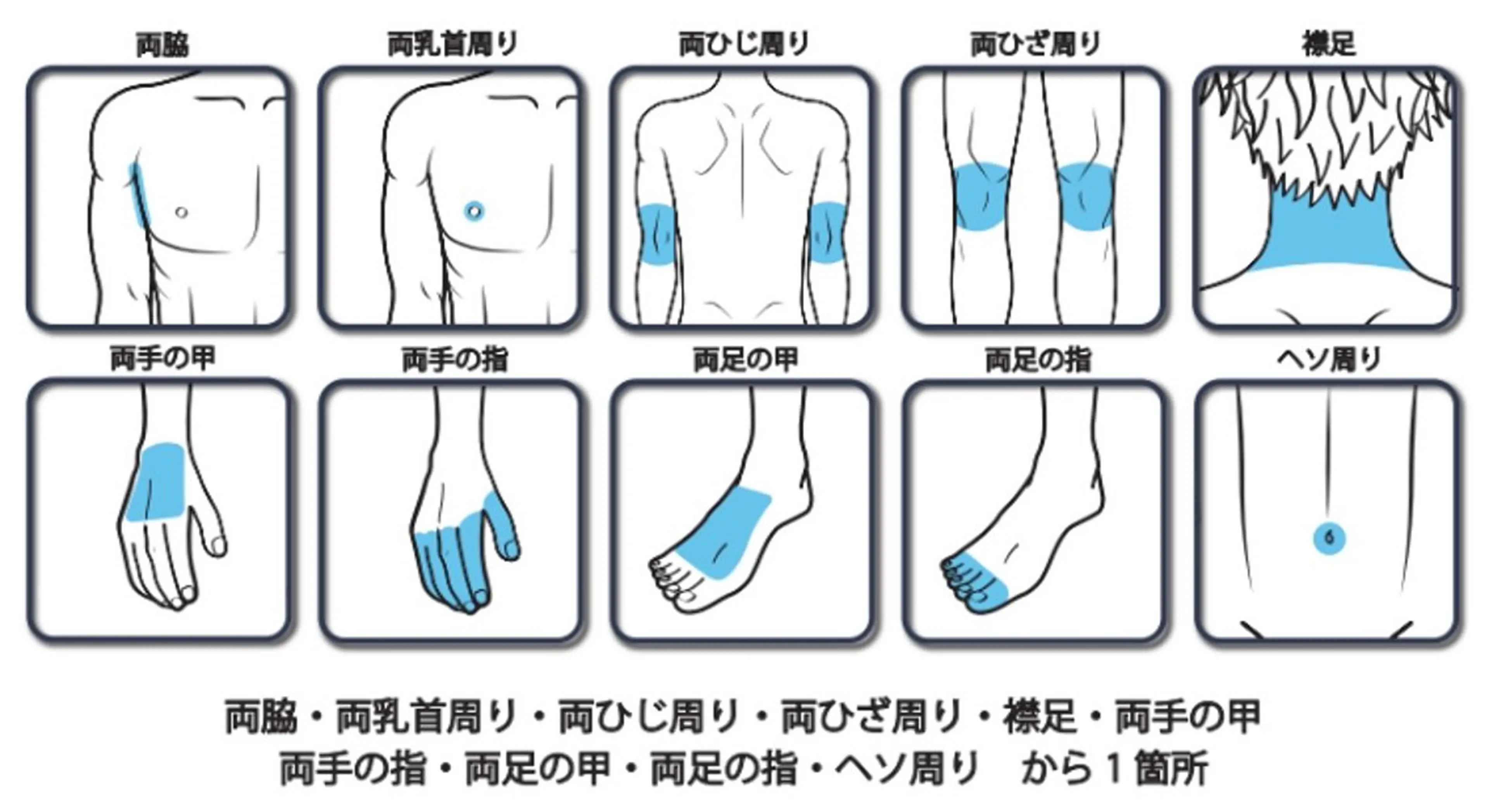 sパーツ脱毛の写真