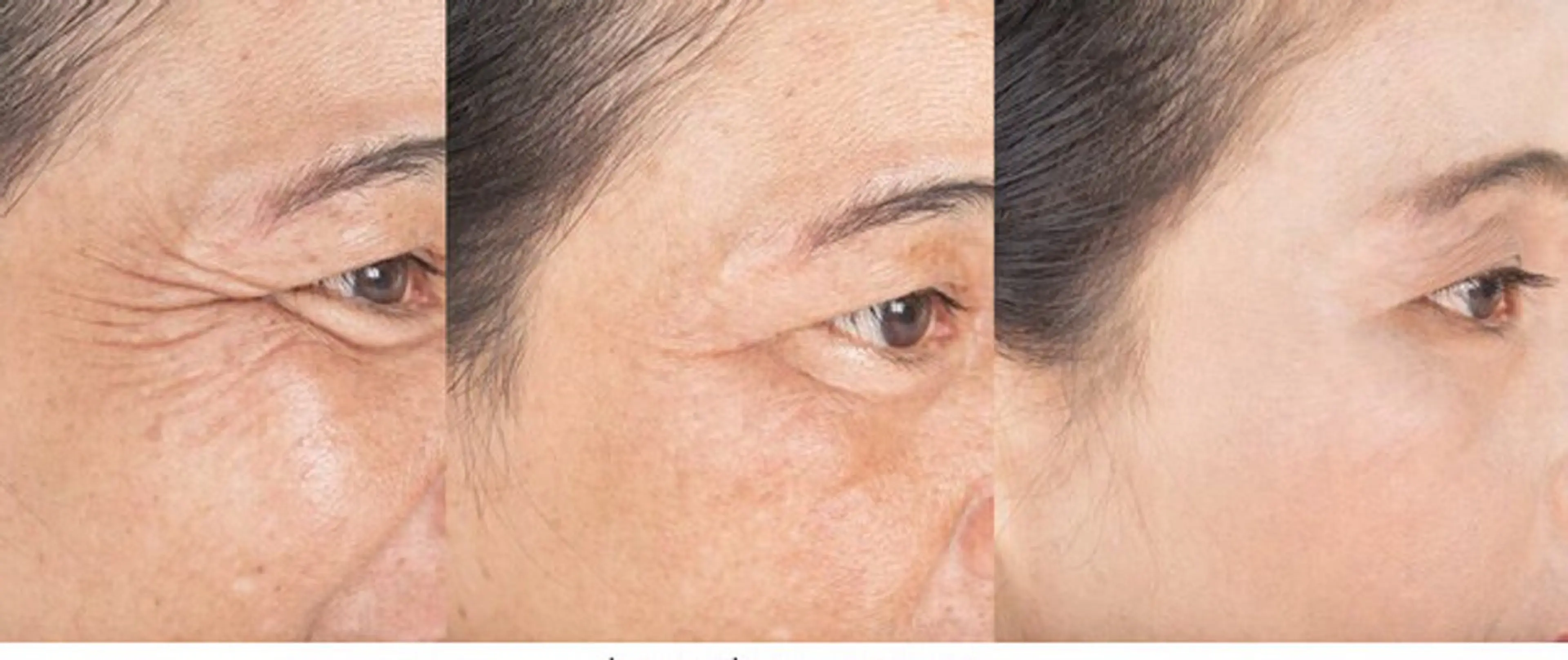 【ほうれい線/しわたるみ改善】深層フェイシャル！生FGF+ヒト幹細胞イオン導入の写真