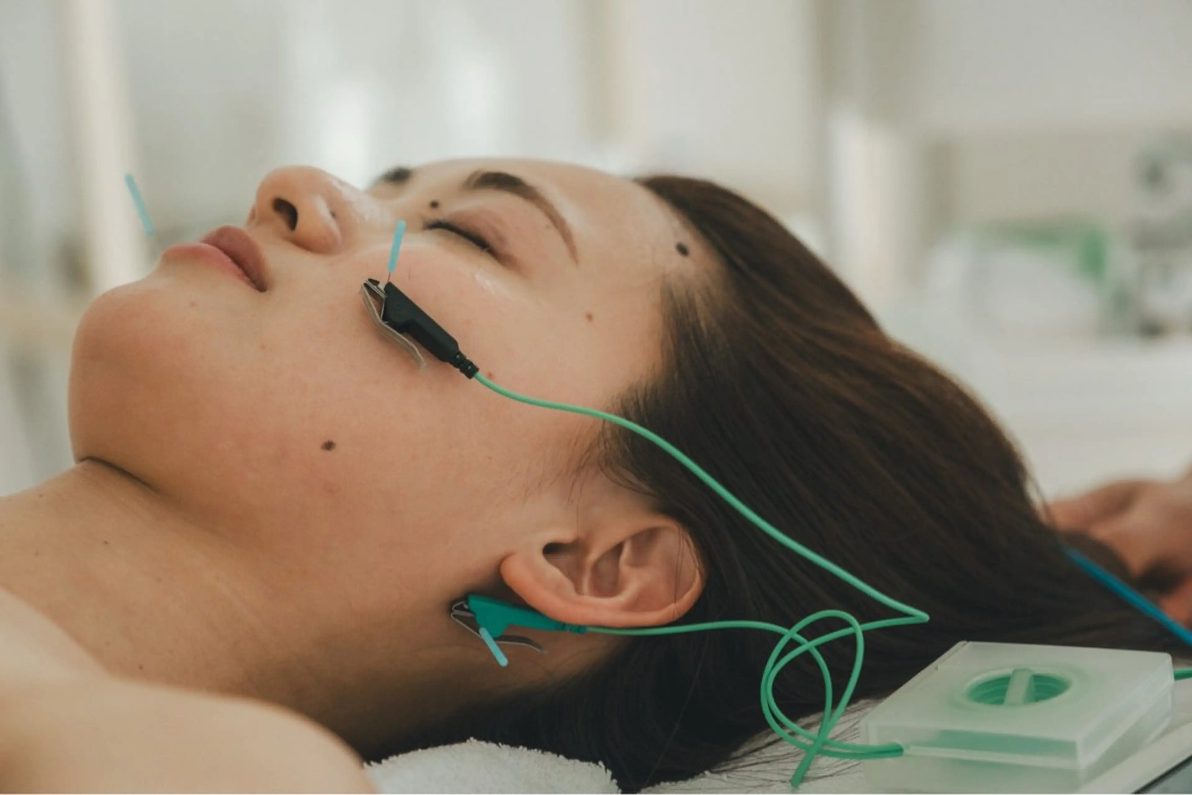 FN美容鍼の写真