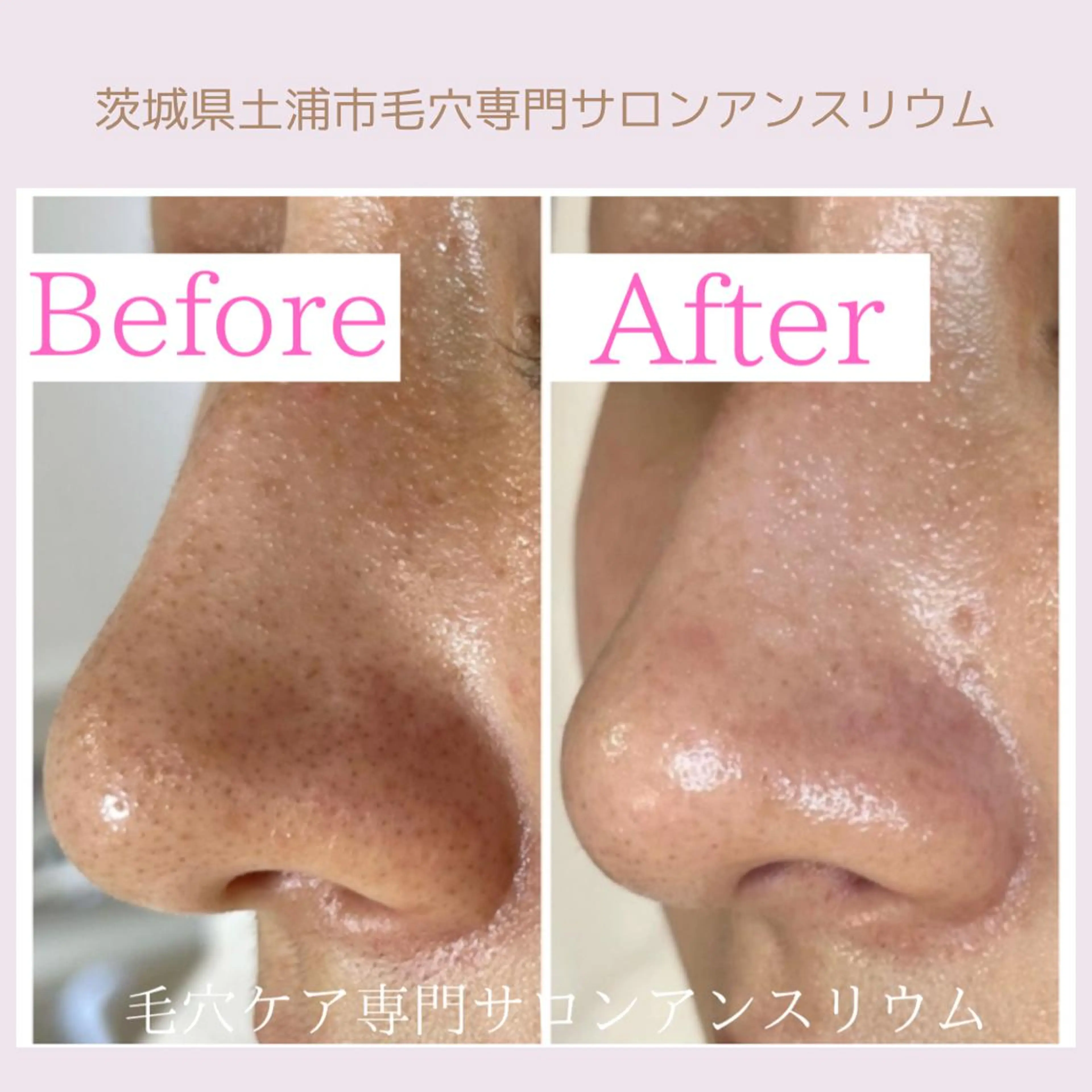 毛穴ケア専門サロンアンスリウム所属・茨城土浦 つくば毛穴 ケア専門サロンのエステ・リラクイメージ