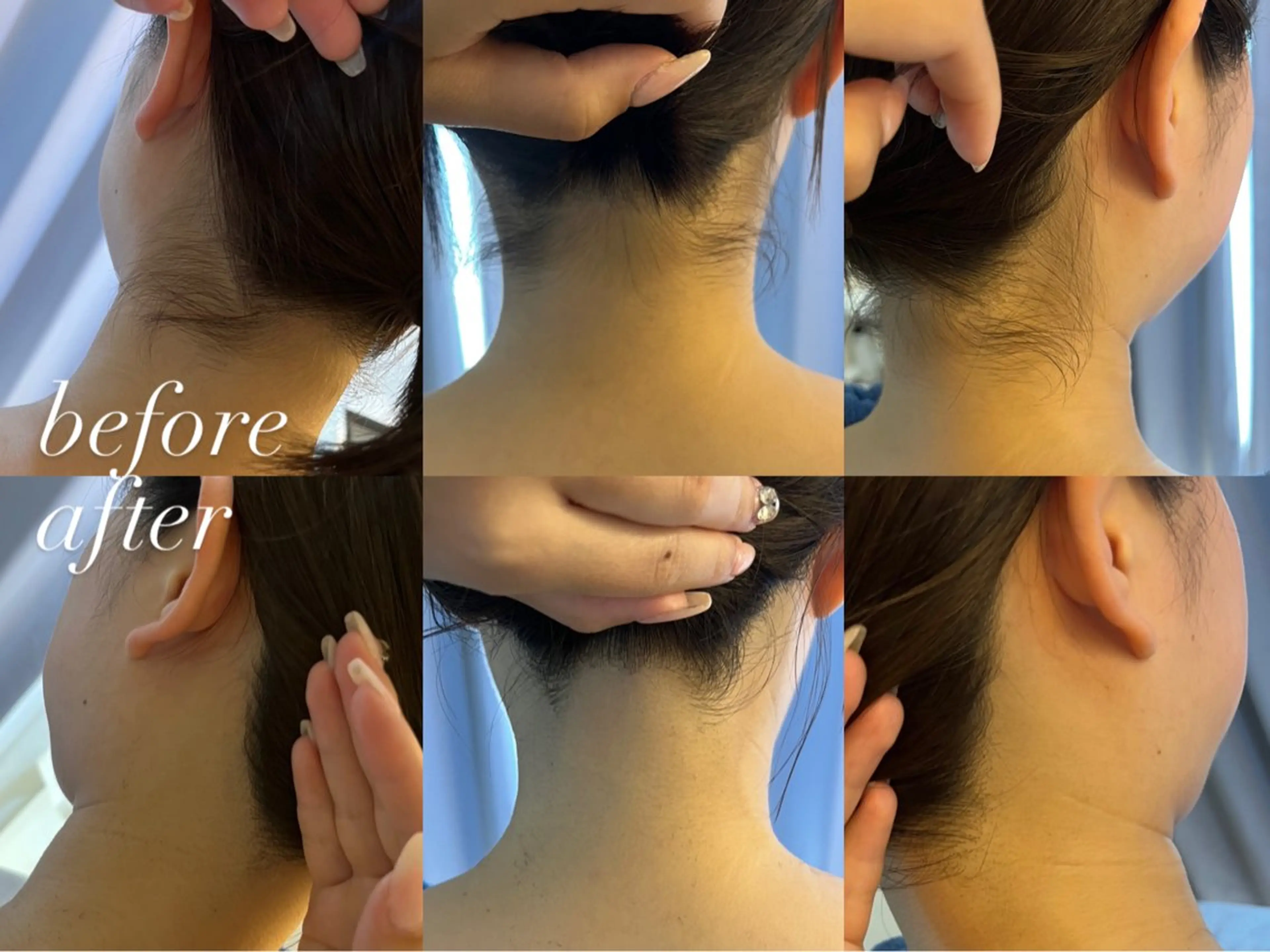 脱毛 うなじ脱毛/美肌脱毛 LABELのエステ・リラクイメージ