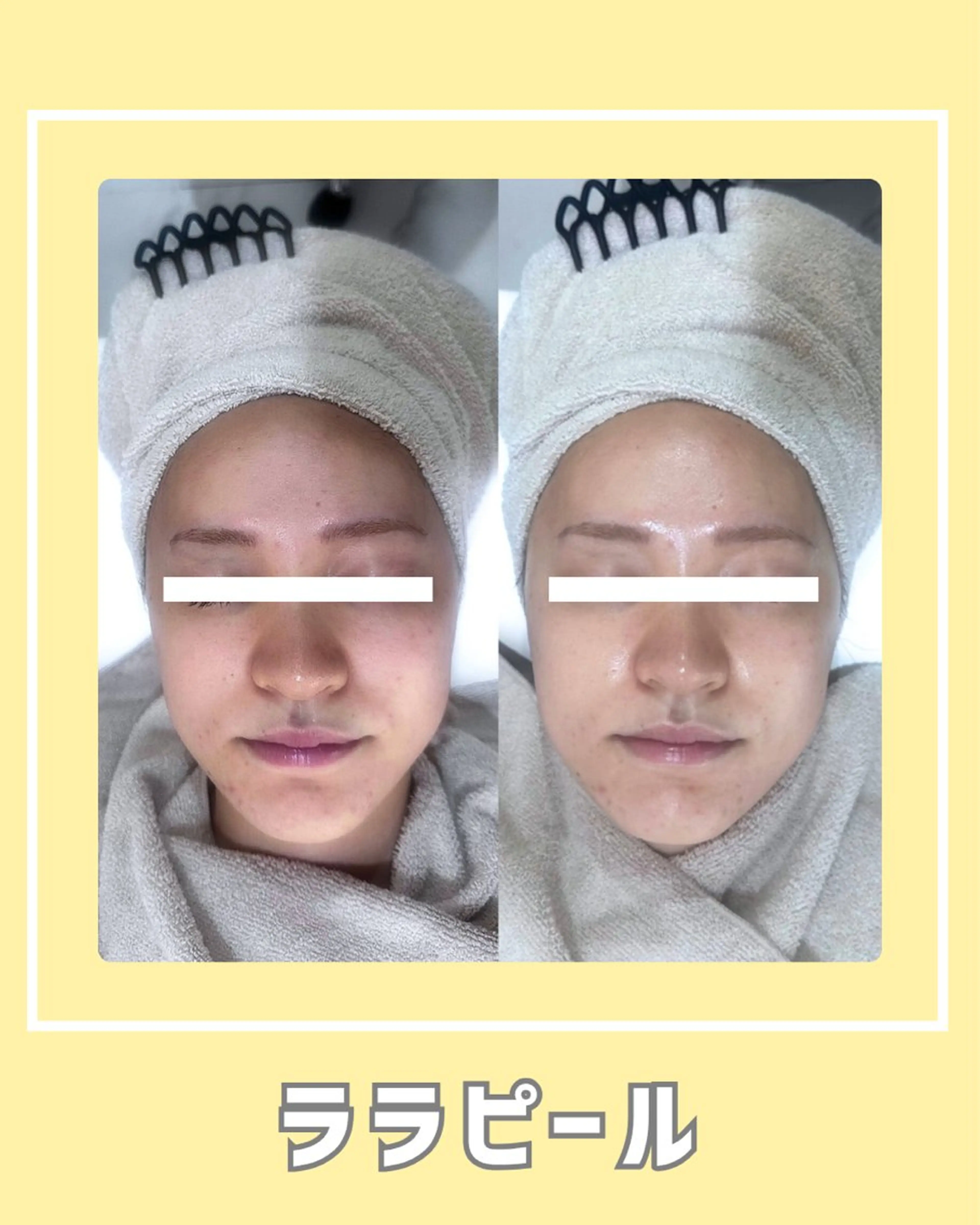 エステ |ピーリング・毛穴| soina神楽坂のエステ・リラクイメージ