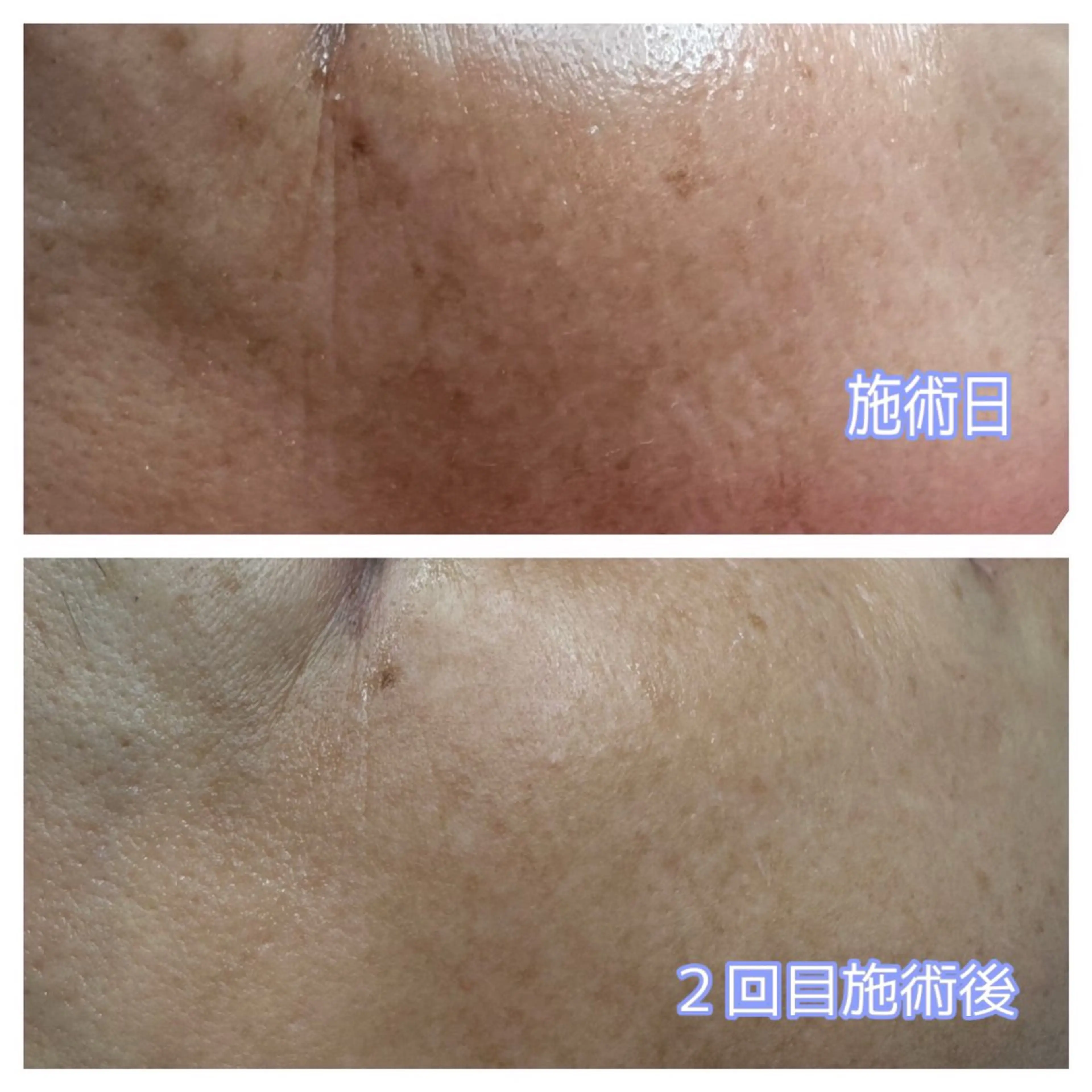 【メンテナンス】光シャワー又は水光ピーリングの写真