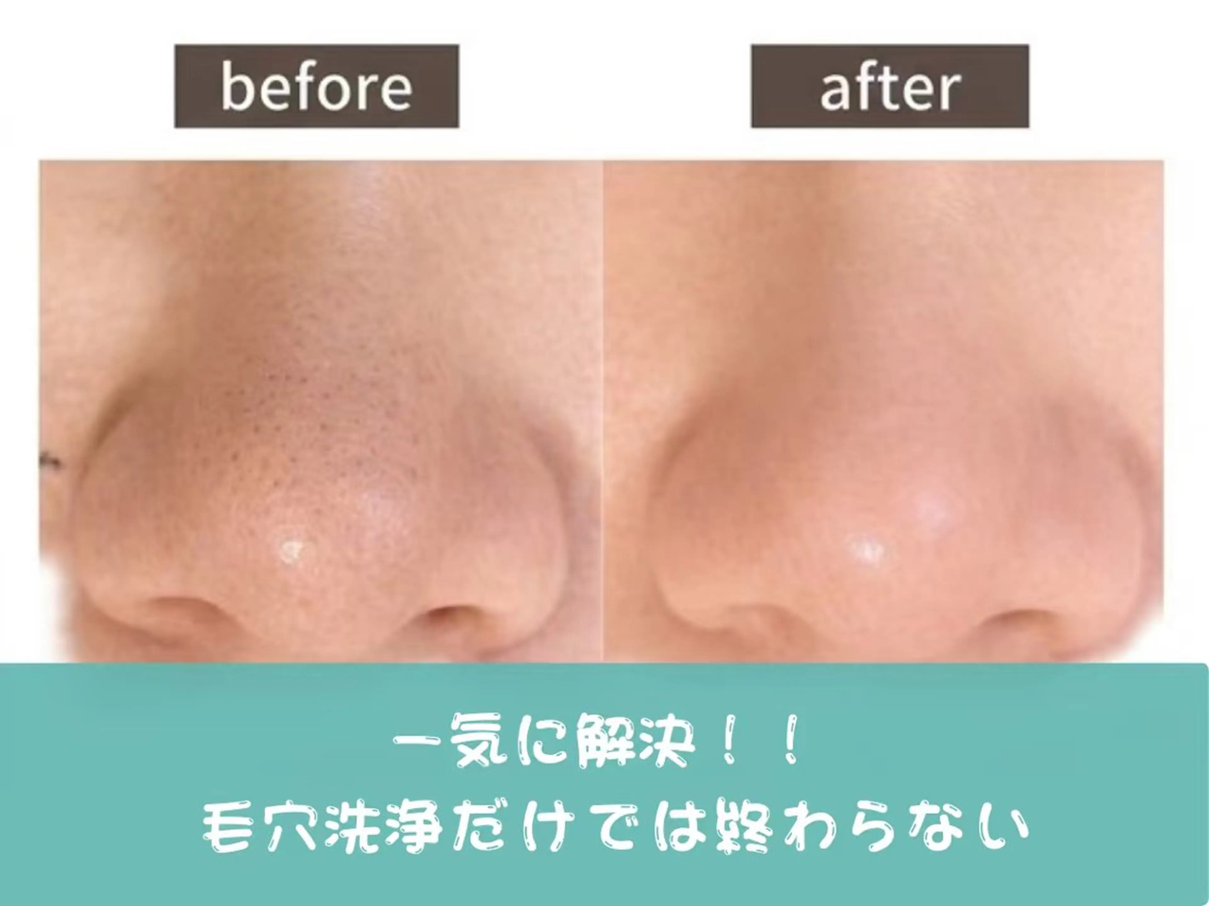 【毛穴洗浄】鼻ハイドラフェイシャル｜黒ずみ・角栓除去の写真