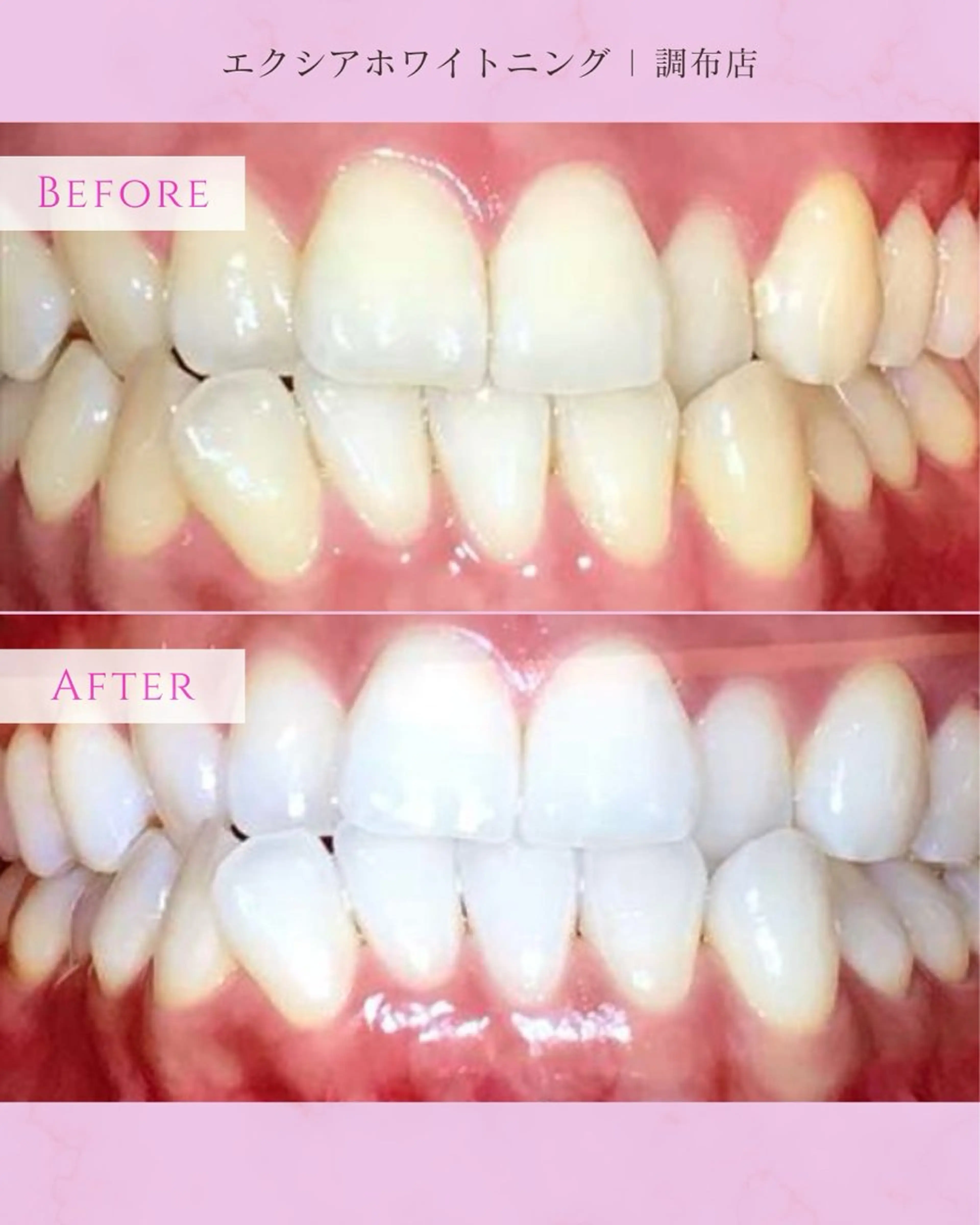 エクシアホワイト調布所属・umi❤︎ ホワイトニングのその他イメージ