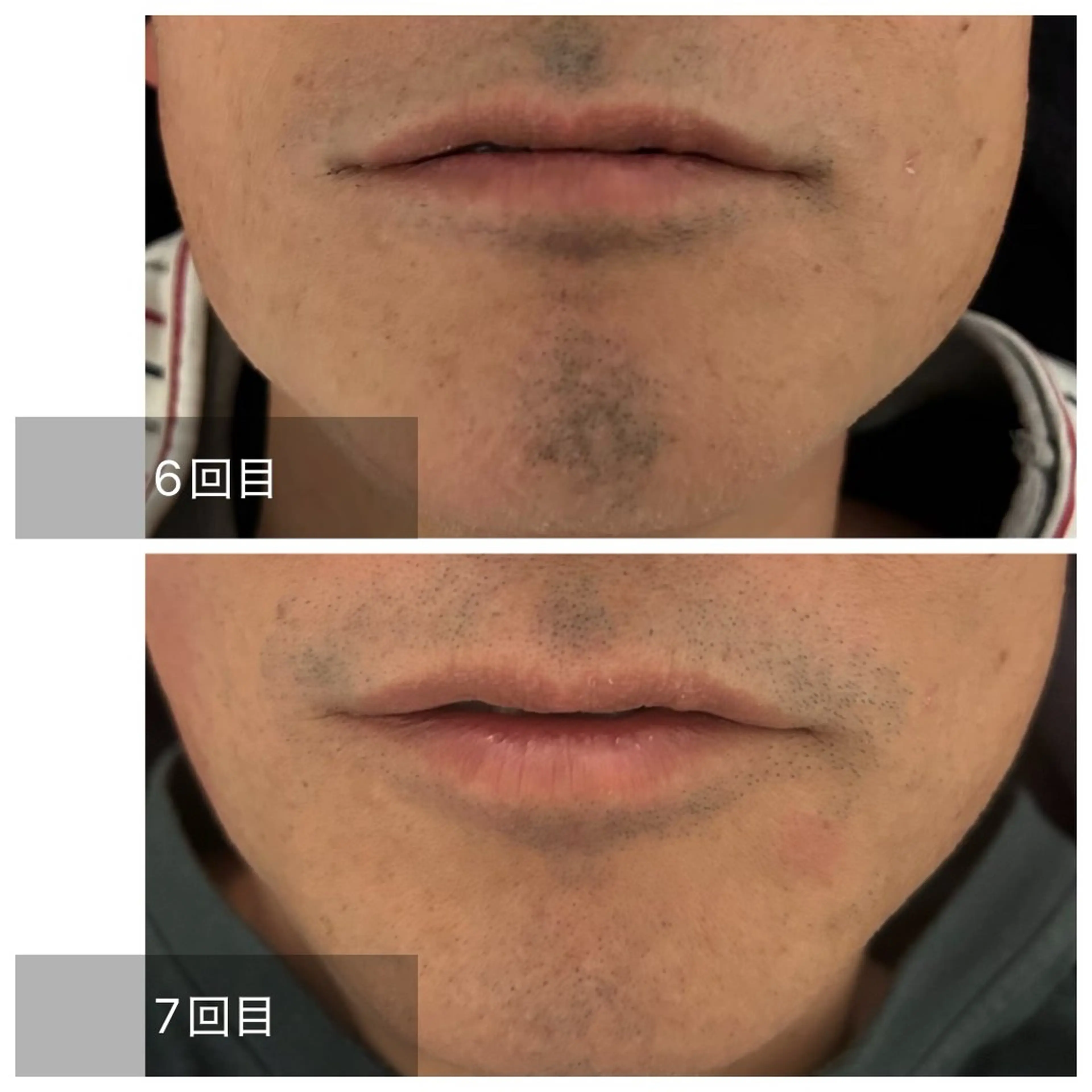 メンズ 脱毛 エマニエル USAのエステ・リラクイメージ