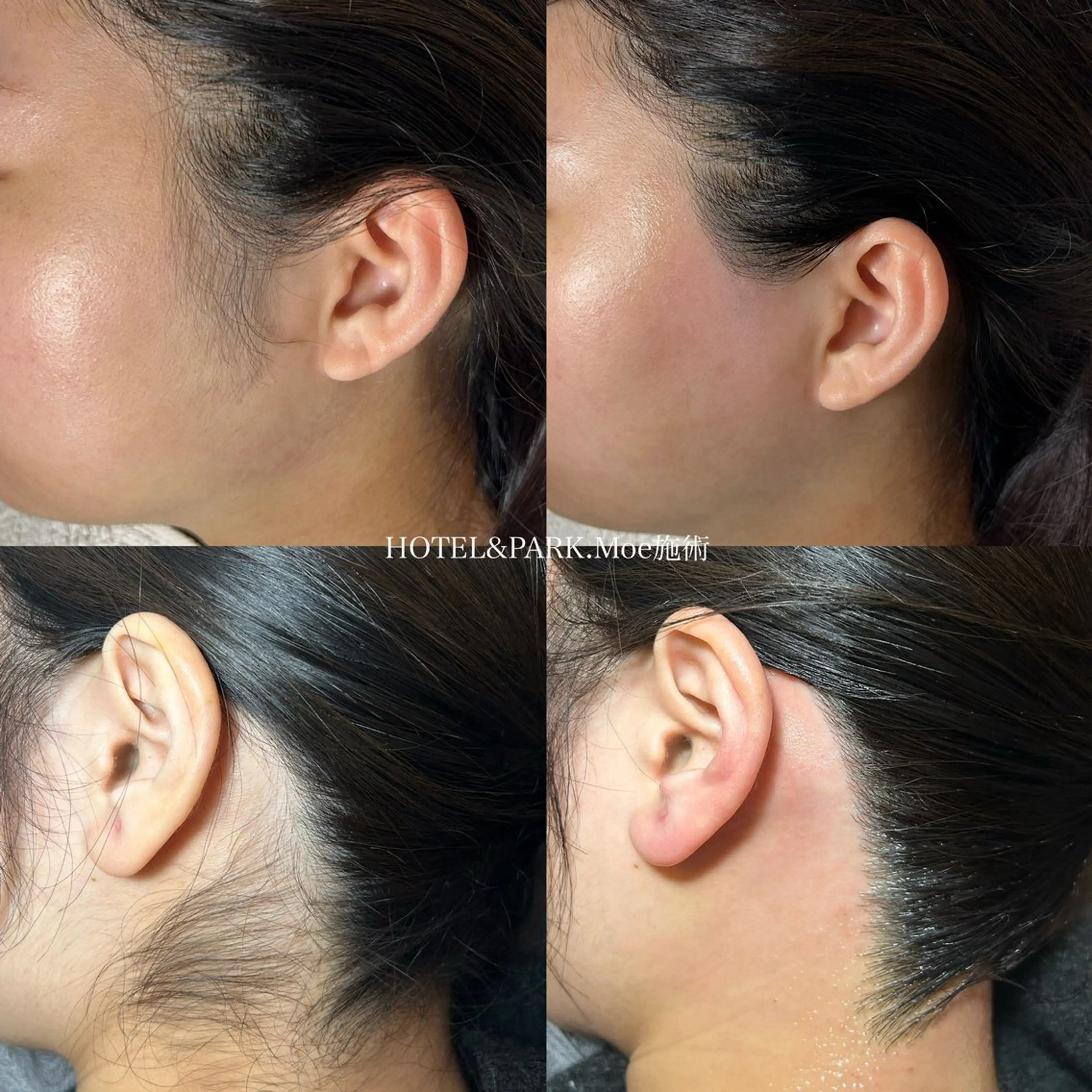 新生活応援🌸【VIO+うなじ+もみあげワックス脱毛】の写真