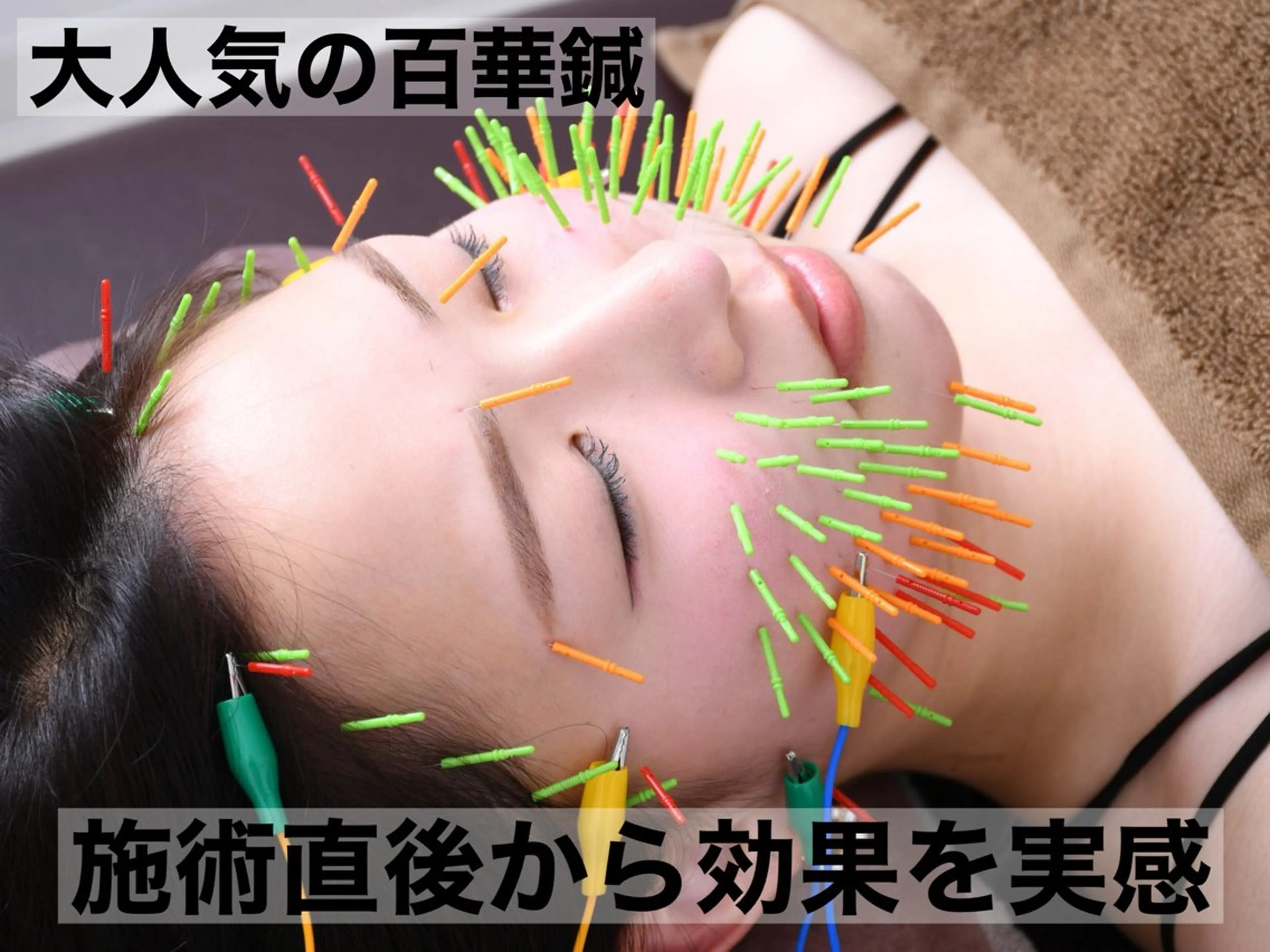 【疲れ顔から卒業】40代からの本格エイジングケア美容鍼（百華鍼）＋小顔矯正（たるみ・ほうれい線）の写真