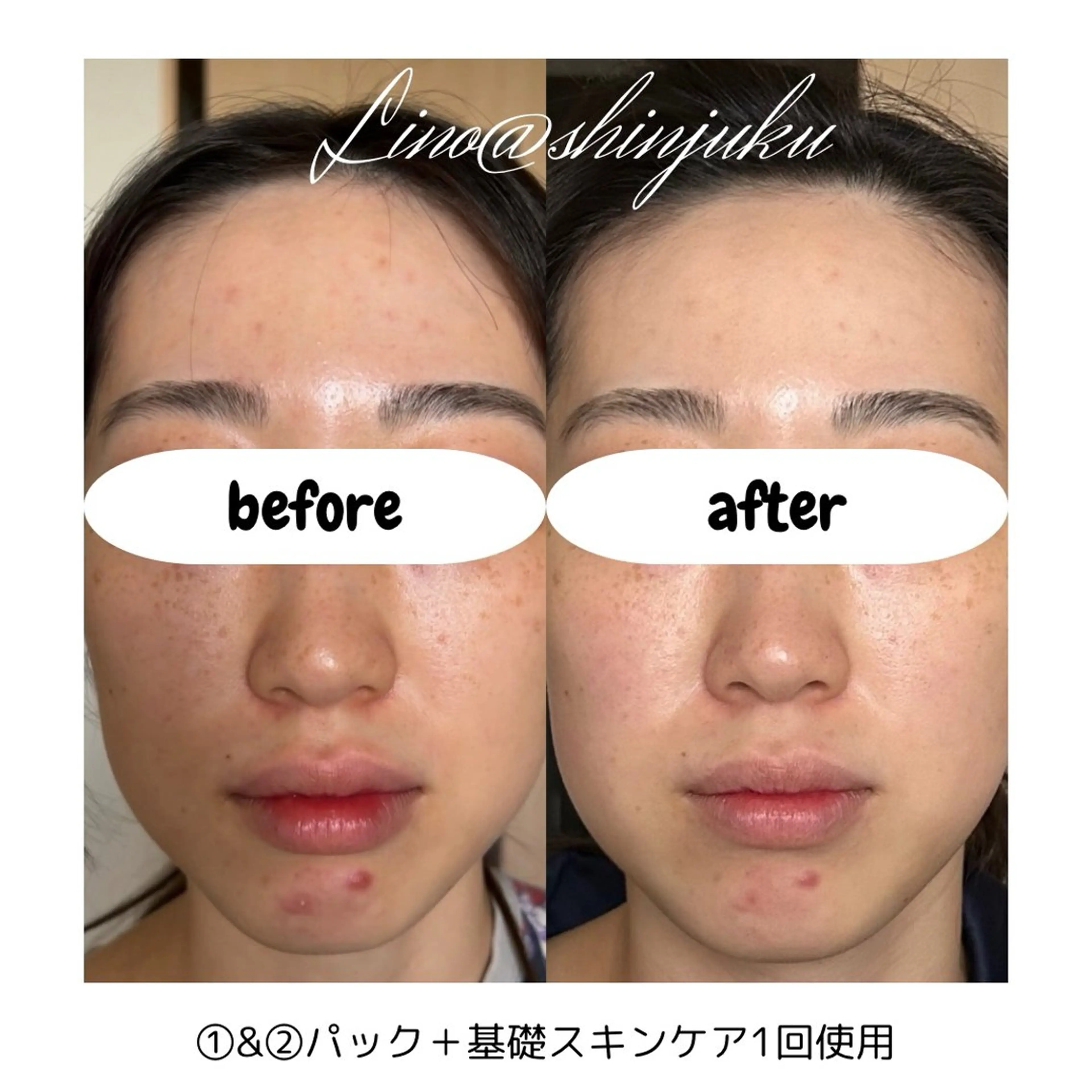 廋身·ハイパーナフ 腸·ヘッドスパ💎モのエステ・リラクイメージ