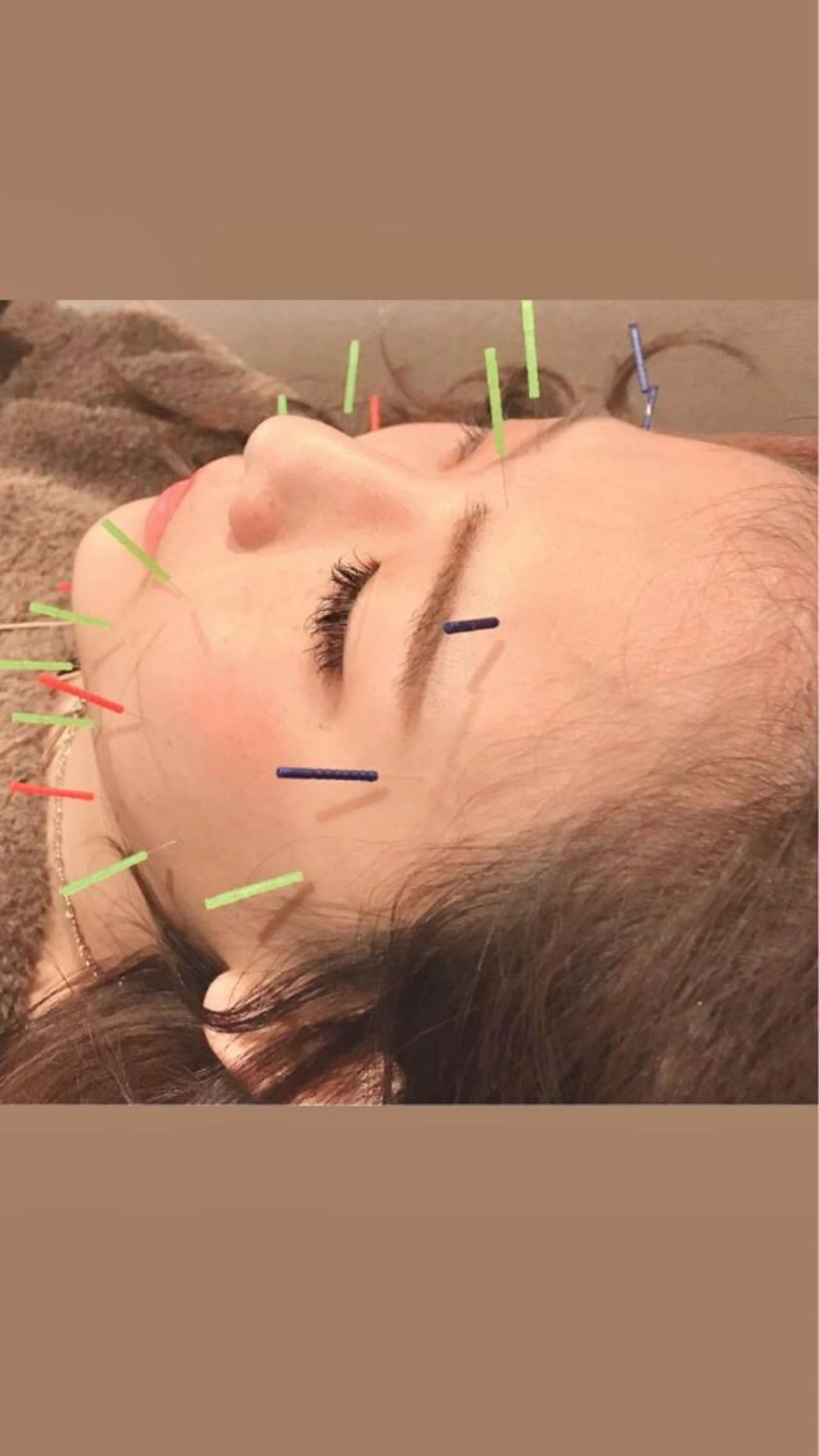 人気の美容鍼✨【ご新規様限定】の写真