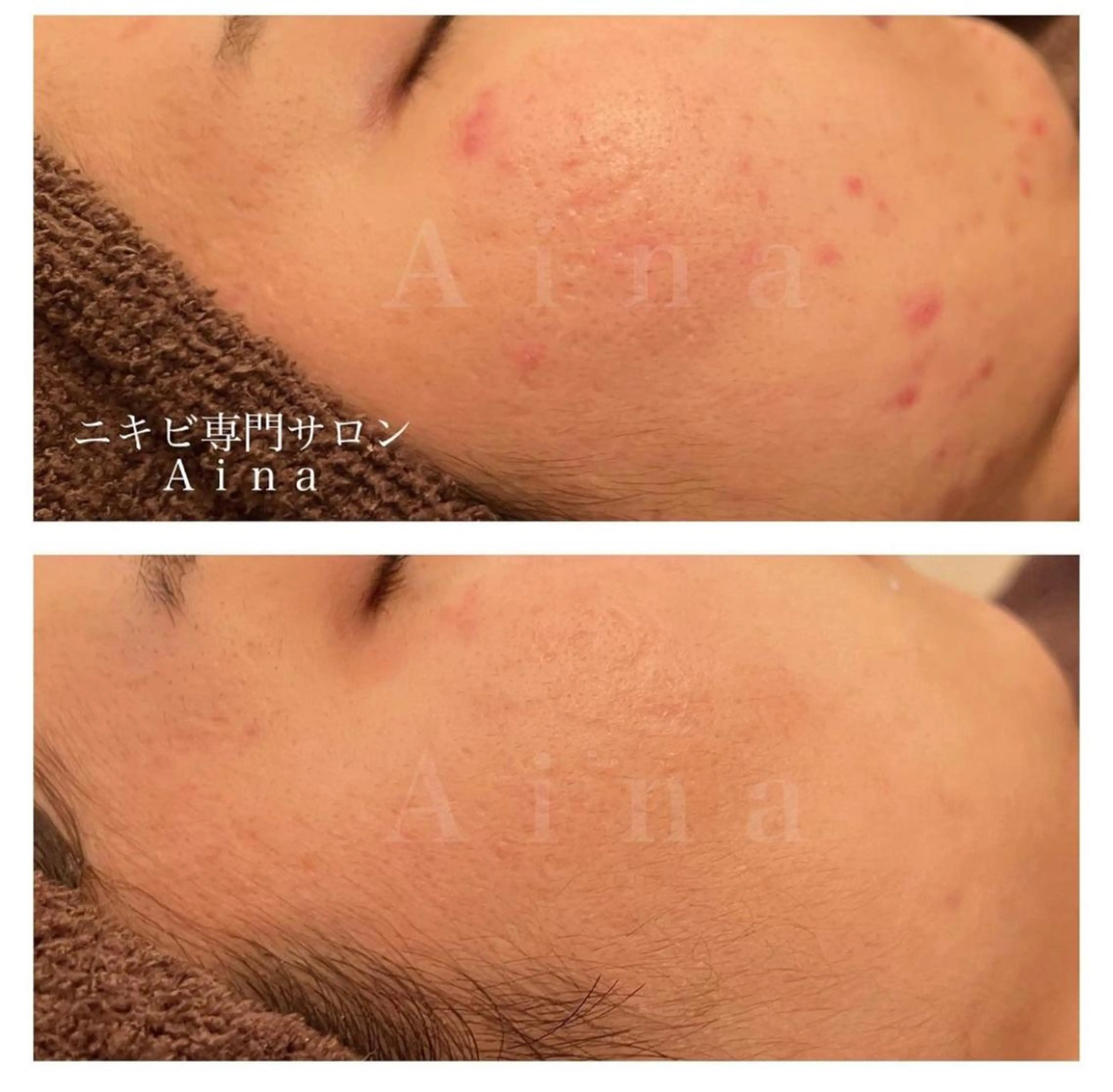 セミロング パーマ ヘアアレンジ メンズ キッズ ネイル マツエク・マツパ アイブロウ 成人式 結婚式・ブライダル 成人式 結婚式・ブライダル 成人式 エステ リラク ニキビ跡専門サロン Ainaのエステ・リラクイメージ