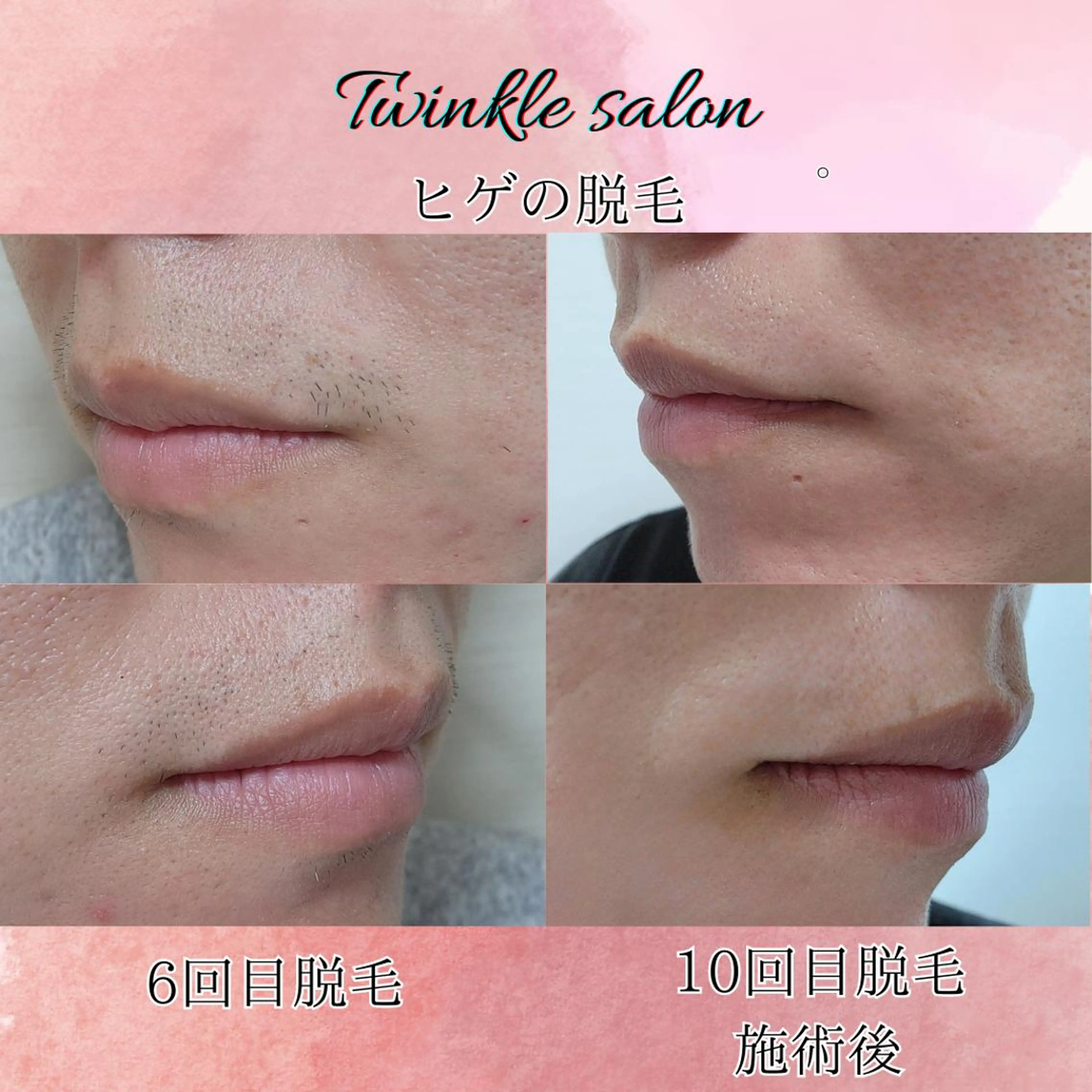 メンズ 脱毛 中井 光明の眉毛・アイブロウイメージ