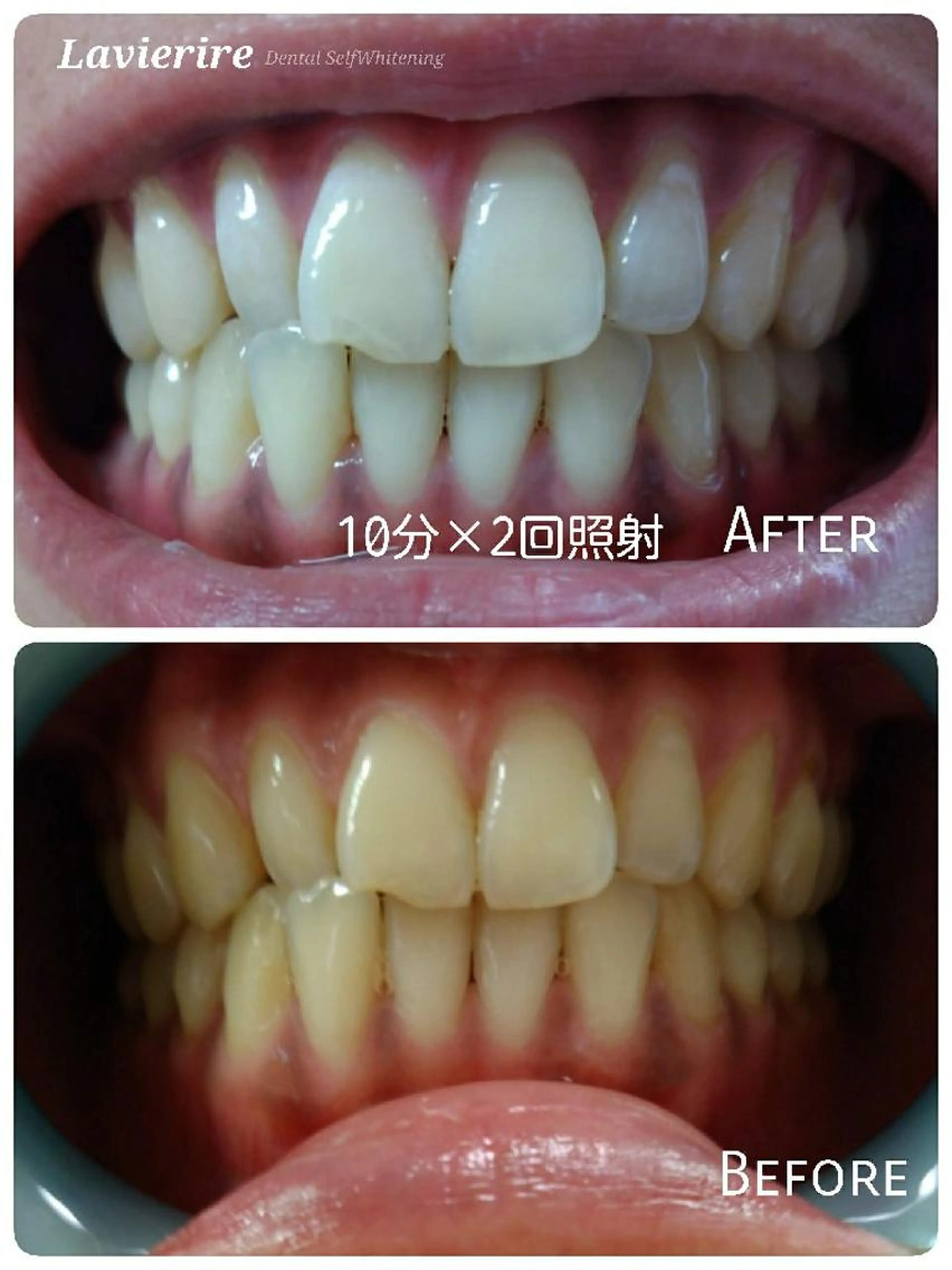 【minimo限定🤩】１回お試し☺✨セルフホワイトニング10分×2回の写真