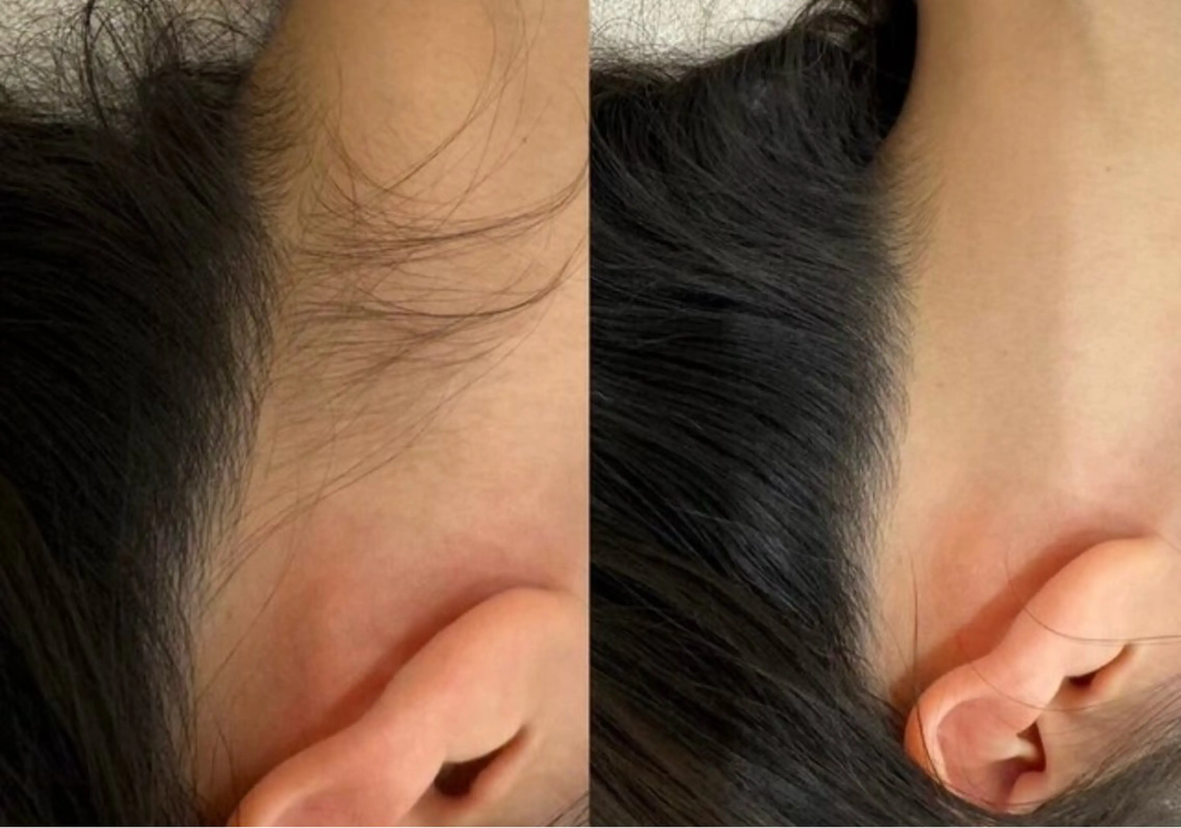 うなじ脱毛の写真