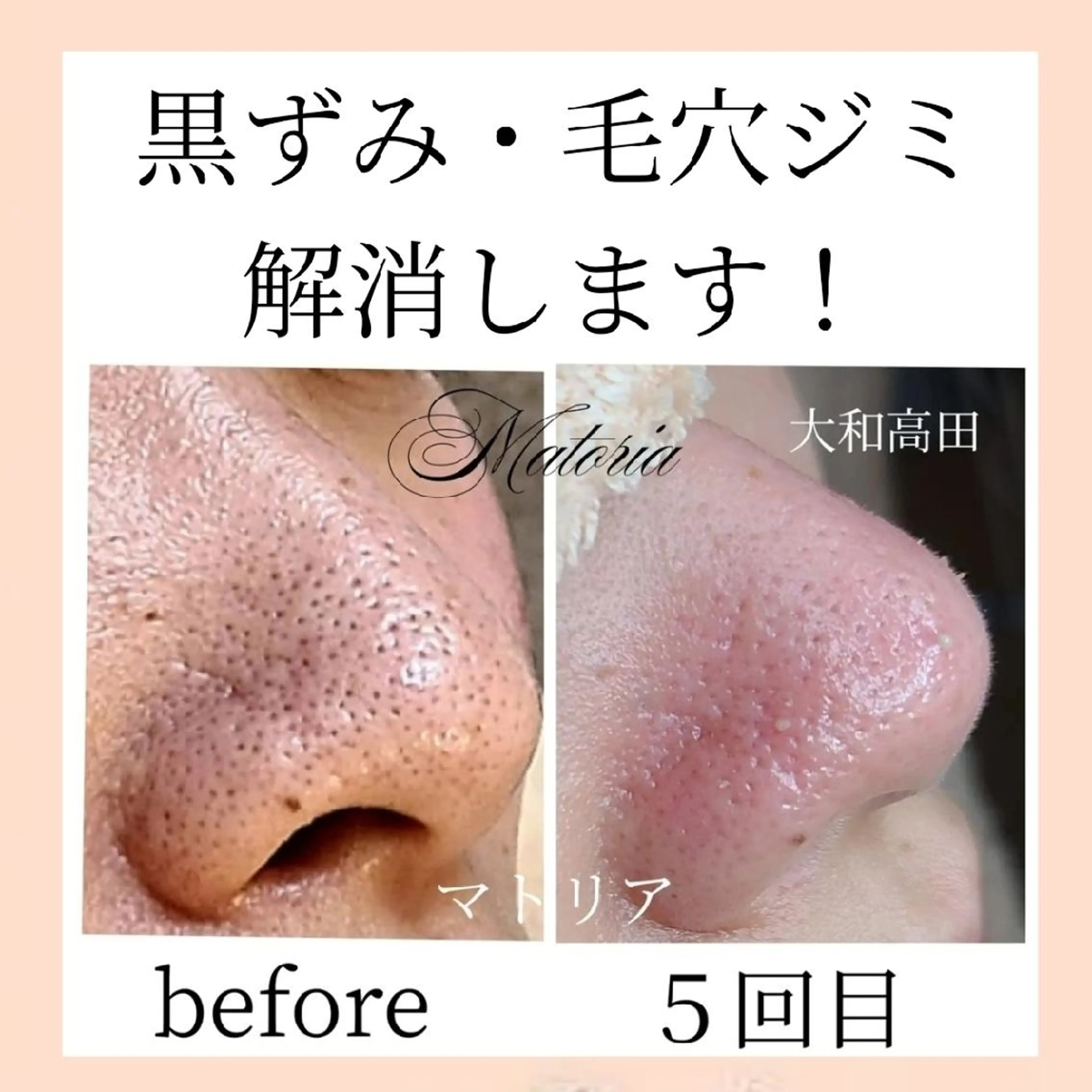 小顔と毛穴　毛穴の汚れ、皮脂詰まり角栓、何をしても取れない黒ずみ徹底的に【毛穴エクストラクション】で取り除きます！の写真